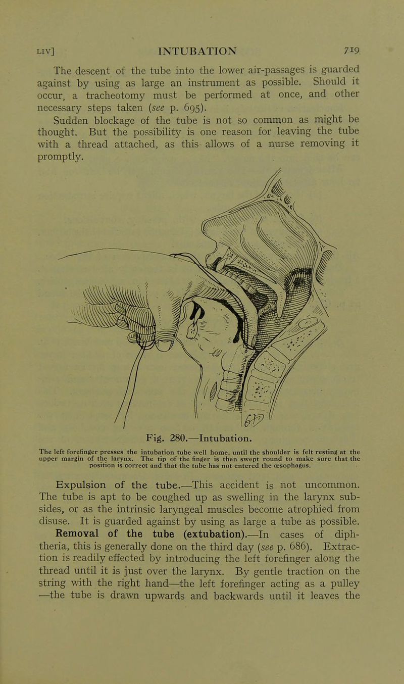 The descent of the tube into the lower air-passages is guarded against by using as large an instrument as possible. Should it occur, a tracheotomy must be performed at once, and other necessary steps taken {see p. 695). Sudden blockage of the tube is not so common as might be thought. But the possibihty is one reason for leaving the tube with a thread attached, as this allows of a nurse removing it promptly. Fig. 280.—Intubation. The left forefinger presses the intubation tube well home, until the shoulder is felt resting at the upper margin of the larynx. The tip of the finger is then swept round to make sure that the position is correct and that the tube has not entered the oesophagus. Expulsion of the tube.—^This accident is not uncommon. The tube is apt to be coughed up as swelling in the larynx sub- sides, or as the intrinsic laryngeal muscles become atrophied from disuse. It is guarded against by using as large a tube as possible. Removal of the tube (extubation).—In cases of diph- theria, this is generally done on the third day {see p. 686). Extrac- tion is readily effected by introducing the left forefinger along the thread until it is just over the larynx. By gentle traction on the string with the right hand—the left forefinger acting as a pulley —the tube is drawn upwards and backwards until it leaves the