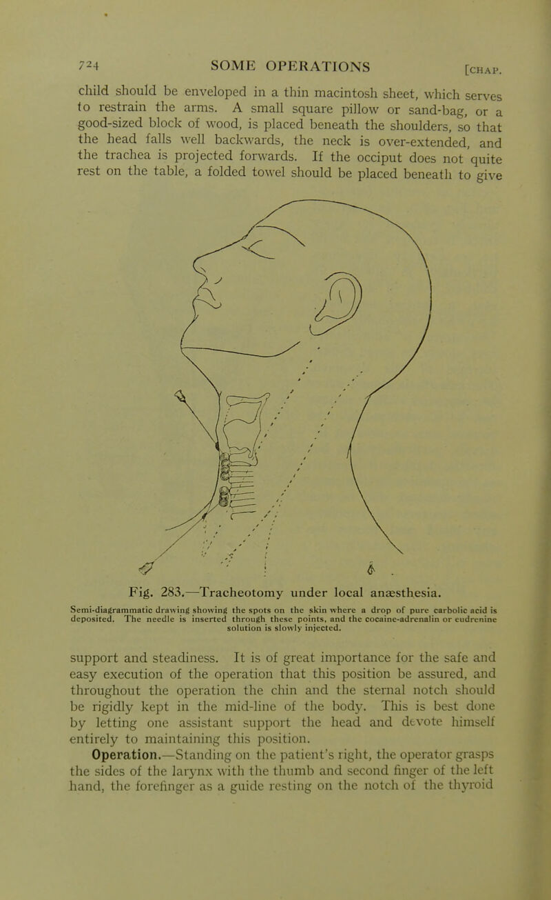 child should be enveloped in a thin macintosh sheet, which serves to restrain the arms. A small square pillow or sand-bag, or a good-sized block of wood, is placed beneath the shoulders, so that the head falls well backwards, the neck is over-extended, and the trachea is projected forwards. If the occiput does not quite rest on the table, a folded towel should be placed beneath to give Fig. 283.—Tracheotomy under local anaesthesia. Semi-diagrammatic drawing showing the spots on the skin where a drop of pure carbolic acid is deposited. The needle is inserted through these points, and the cocaine-adrenalin or cudrenine solution is slowly injected. support and steadiness. It is of great importance for the safe and easy execution of the operation that this position be assured, and throughout the operation the chin and the sternal notch should be rigidly kept in the mid-line of the body. This is best done by letting one assistant support the head and devote himself entirely to maintaining this position. Operation.—Standing on the patient's right, the operator grasps the sides of the larynx with the thumb and second finger of the left hand, the forefinger as a guide resting on the notch of the thj-roid