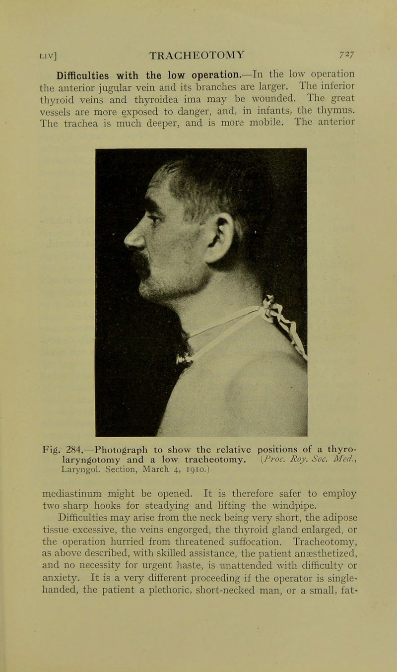 Difficulties with the low operation.—In the low operation the anterior jugular vein and its brandies are larger. The inferior thyroid veins and thyroidea ima may be wounded. The great vessels are more exposed to danger, and, in infants, the thymus. The trachea is much deeper, and is more mobile. The anterior Fig. 284.—Photograph to show the relative positions of a thyro- laryngotomy and a low tracheotomy. (/Vo^r. Roy. Soc. Med., Laryngol. Section, March 4, 1910.) mediastinum might be opened. It is therefore safer to employ two sharp hooks for steadying and lifting the windpipe. Difficulties may arise from the neck being very short, the adipose tissue excessive, the veins engorged, the thyroid gland enlarged, or the operation hurried from threatened suffocation. Tracheotomy, as above described, with skilled assistance, the patient annesthetized, and no necessity for urgent haste, is unattended with difficulty or anxiety. It is a very different proceeding if the operator is single- handed, the patient a plethoric, short-necked man, or a small, fat-
