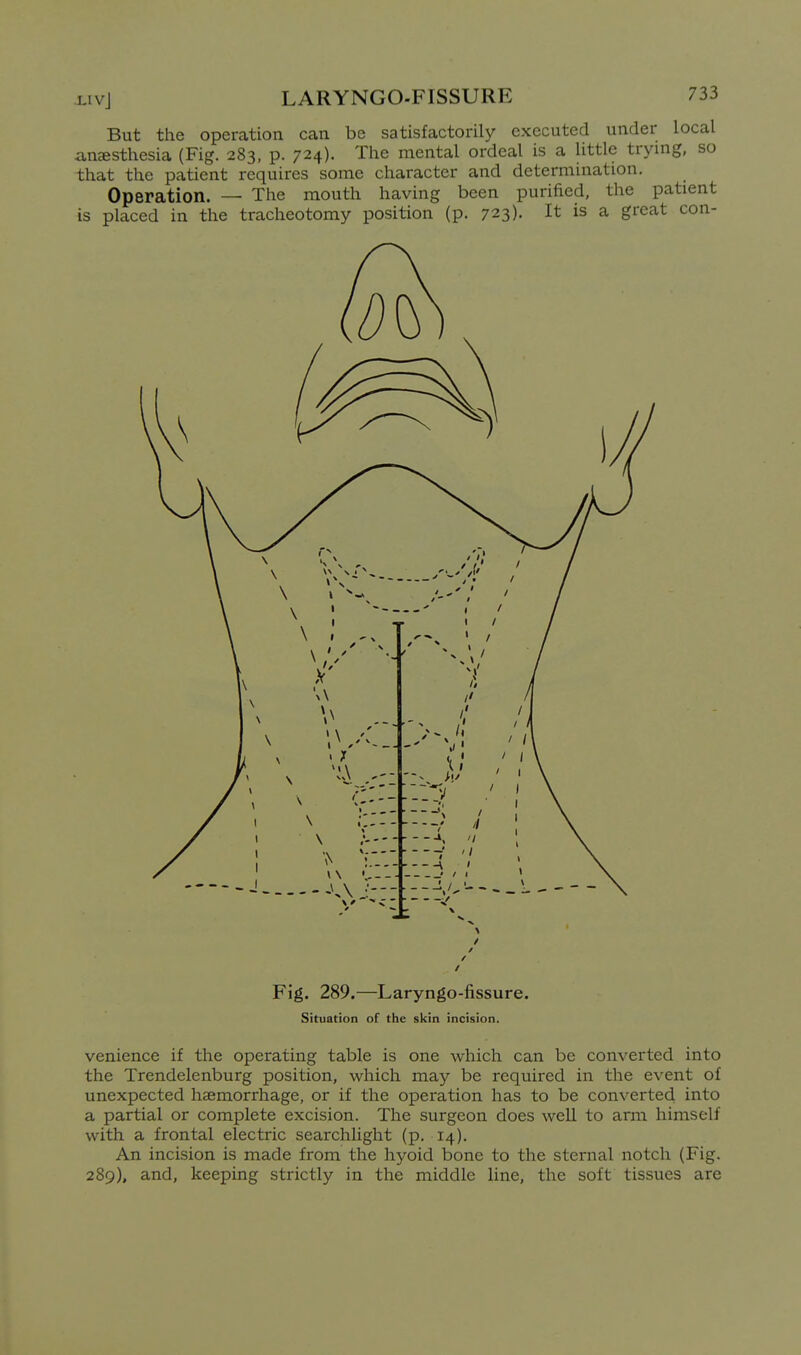But the operation can be satisfactorily executed under local anesthesia (Fig. 283, p. 724). The mental ordeal is a Uttle trying, so that the patient requires some character and determination. Operation. — The mouth having been purified, the patient is placed in the tracheotomy position (p. 723)- It is a great con- Fig. 289.—Laryngo-fissure. Situation of the skin incision. venience if the operating table is one which can be converted into the Trendelenburg position, which may be required in the event of unexpected haemorrhage, or if the operation has to be converted into a partial or complete excision. The surgeon does well to arm himself with a frontal electric searchlight (p. 14). An incision is made from the hyoid bone to the sternal notch (Fig. 289), and, keeping strictly in the middle line, the soft tissues are
