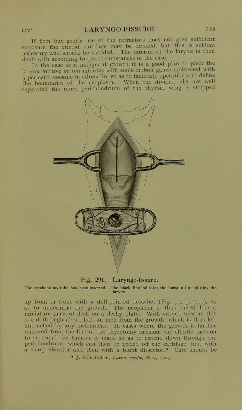 If firm but gentle use of the retractors does not give sufficient exposure the cricoid cartilage may be divided, but this is seldom necessary and should be avoided. The interior of the larynx is then dealt with according to the circumstances of the case. In the case of a malignant growth it is a good plan to pack the larynx for five or ten minutes with some ribbon gauze moistened with 5 per cent, cocaine in adrenalin, so as to facihtate operation and define the boundaries of the neoplasm. When the divided alae are well separated the inner perichondrium of the thyroid wing is stripped V Fig. 291.—Laryngo-fissure. The tracheotomy tube has been inserted. The black line indicates the incision for splitting the larynx. up from in front with a dull-pointed detacher (Fig. 99, p. 199), so as to undermine the growth. The neoplasm is thus raised like a miniature mass of flesh on a fleshy plate. With curved scissors this is cut through about half an inch from the growth, which is thus left untouched by any instrument. In cases where the growth is farther removed from the line of the thyrotomy incision, the elliptic incision to surround the tumour is made so as to extend down through the perichondrium, which can then be peeled off the cartilage, first with a sharp elevator and then with a blunt dissector.* Care should be • J. Solis-Cohen, Laryngoscope, May, 1907.