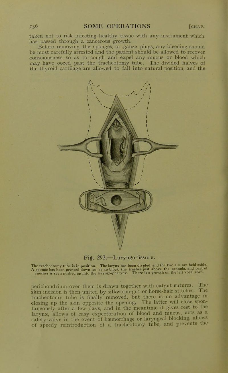 taken, not to risk infecting healthy tissue with any instrument which has passed through a cancerous growth. Before removing the sponges, or gauze plugs, any bleeding should be most carefully arrested and the patient should be allowed to recover consciousness, so as to cough and expel any mucus or blood which may have oozed past the tracheotomy tube. The divided halves of the thyi'oid cartilage are allowed to fall into natural position, and the Fig. 292.—Laryngo-fissure. The tracheotomy tube is in position. The larynx has been divided, and the two ala: arc held aside. A sponge has been pressed down so as to bloci< the trachea just above the cannula, and part ol another is seen pushed up into the laryngo-pharynx. There is a growth on the left vocal cord. perichondrium over them is drawn together with catgut sutures. The skin incision is then united by silkworm-gut or horse-hair stitches. The tracheotomy tube is finally removed, but there is no advantage m closing up the skin opposite the opening. The latter will close spon- taneously after a few days, and in the meantime it gives rest to the larynx, allows of easy expectoration of blocd and mucus, acts as a safety-valve in the event of haemorrhage or laryngeal blocking, allows of speedy reintroduction of a tracheotomy tube, and prevents the