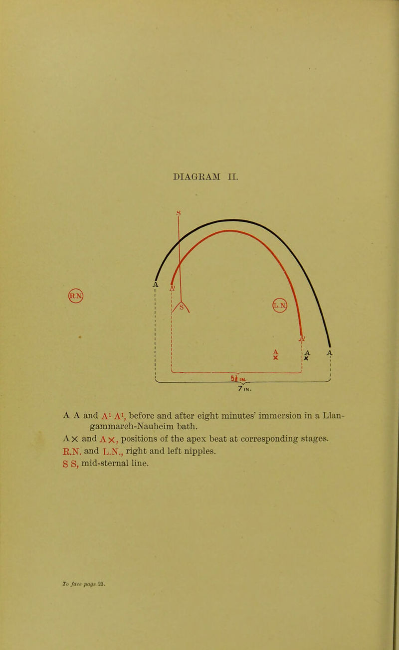 DIAGRAM II. A A and A^ A', before and after eight minutes' immersion in a Llan- gammarch-Nauheim bath. A X and A x, positions of the apex beat at corresponding stages. R.N. and L.N., right and left nipples. S S, mid-sternal line.