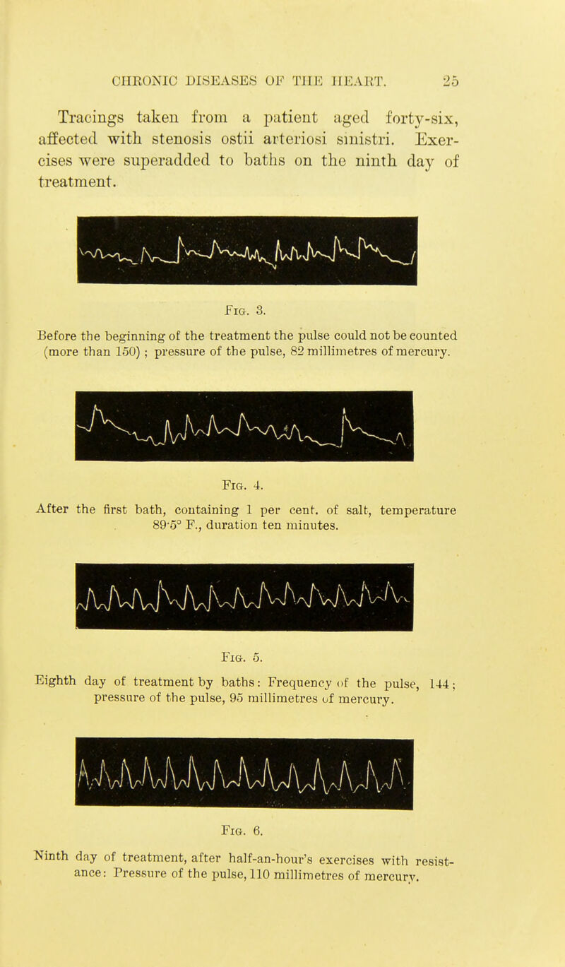 Tracings taken from a patient aged forty-six, affected with stenosis ostii arteriosi smistri. Exer- cises were superadded to baths on the ninth day of treatment. Fig. 3. Before the beginning of the treatment the pulse could not be counted (more than 150); pressure of the pulse, 82 millimetres of mercury. Fig. 4. After the first bath, containing 1 per cent, of salt, temperature 89'5° F., duration ten minutes. Fig. o. Eighth day of treatment by baths: Frequency of the pulse, 144; pressure of the pulse, 95 millimetres of mercury. Ninth day of treatment, after half-an-hour's exercises with resist- ance: Pressure of the pulse, 110 millimetres of mercury.