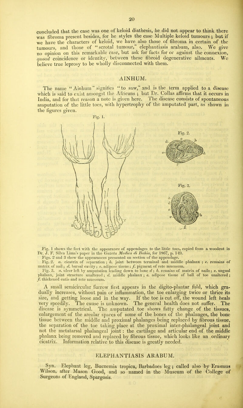 concluded that the case was one of keloid diathesis, lie did not appear to think there was fibroma present besides, for he styles the case Multiple keloid tumours ; but if we have the characters of keloid, we have also those of fibroma in certain of the tumours, and those of scrotal tumour, elephantiasis arabum, also. We give no opinion on this remarkable case, but ask for facts for or against the connexion, quoad coincidence or identity, between these fibroid degenerative ailments. Wc believe true leprosy to be wholly disconnected with them. AINHUM. The name  Ainhum signifies to saw, and is the term applied to a disease which is said to exist amongst the Africans ; but Dr. Collas affirms that it occurs in India, and for that reason a note is given here. The disease consists of spontaneous amputation of the little toes, with hypertrophy of the amputated part, as shown in the figures given. Fig. 1. Fig. 1 shows tlie feet with the appearance of appendages to the little toes, copied from a woodcut in Dr. J. F. Silva Lima's paper in the Gazeta Mcdica di BaJiia, for 1867, p. 149. Figs. 2 and 3 show the appearances presented on section of the appendage. Fig. 2. a. cicatrix of separation ; h. joint between terminal and middle phalanx ; c. remains of matrix of nail; d. bursal cavity; c. adipose tissue; f. pigment of rete mucosum. Fig. 3. a. ulcer left by amputation leading down to bone d ; h. remains of matrix of nails; c. ungual phalanx, joint structure unaltered; d. middle phalanx ; e. adipose tissue of ball of toe unaltered ; /. thickened cutis and rete mucosum. A small semicircular furrow first appears in the digito-plantar fold, which gra- dually increases, without pain or inflammation, the toe enlarging twice or thrice its size, and getting loose and in the way. If the toe is cut off, the wound left heals very speedily. The cause is unknown. The general health does not suflTer. The disease is symmetrical. The amputated toe sliows fatty change of the tissues, enlargement of the areolar spaces of some of the bones of the phalanges, the bone tissue between the middle and proximal phalanges being replaced by fibrous tissue, the separation of the toe taking place at the proximal inter-phalangeal joint and not the metatarsal phalangeal joint: the cartilage and articular end of the middle phalanx being removed and replaced by fibrous tissue, which looks like an ordinary cicatrix. Information relative to this disease is greatly needed. ELEPHANTIASIS ARABUM. Syn. Elephant leg, Bucnemia tropica, Barbadoes leg; called also by Erasmus Wilson, after Mason Good, and so named in the Museum of the College of Surgeons of England, Spargosis.