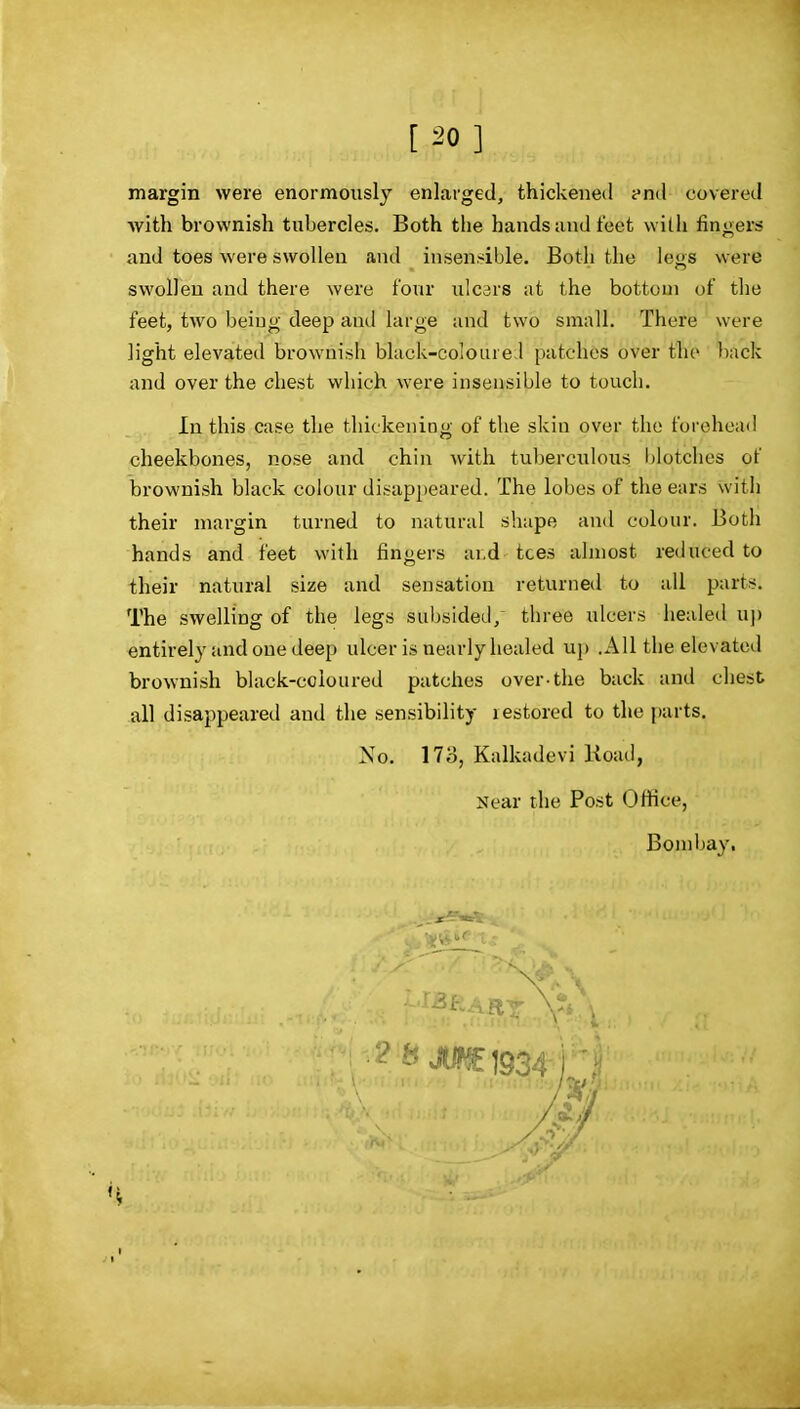 margin were enormously enlarged, thickened ?nd covered with brownish tubercles. Both the hands and feet with fingers and toes were swollen and insensible. Both the leys were swollen and there were four ulcars at the bottom of the feet, two beiug deep ami large and two small. There were light elevated browuisli black-colouiei patches over the l)ack and over the chest which were insensible to touch. In this case the thickening of the skin over the forehead cheekbones, nose and chin with tuberculous blotches of brownish black colour disappeared. The lobes of the ears with their margin turned to natural shape and colour. Both hands and feet with fingers ai.d tees almost reduced to their natural size and sensation returned to all parts. The swelling of the legs subsided, three ulcers healed up entirely and one deep ulcer is nearly healed up .AH the elevated brownish black-coloured patches over-the back and chest all disappeared and the sensibility restored to the parts. Xo. 17o, Kalkadevi Road, Near the Post Office, Bombay.