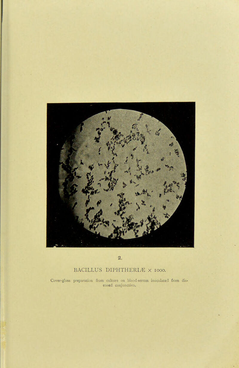 2. BACILLUS DIPHTHERIA x looo. Cover-ghss preparation from culture on blood-serum inoculated from dis- eased conjunctiva.