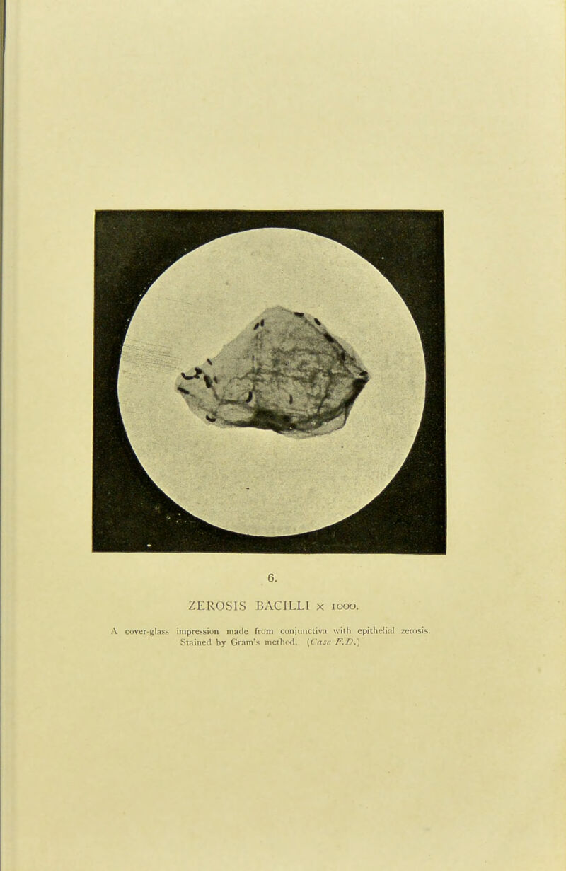 6. ZEROS IS BACILLI x iocx>. A cover-glass iiripressiiiii iiiailc from cuniiiiictiv.-i with epithe'.inl zerosis. Stained by Gram's method. {Cttse F.D.)