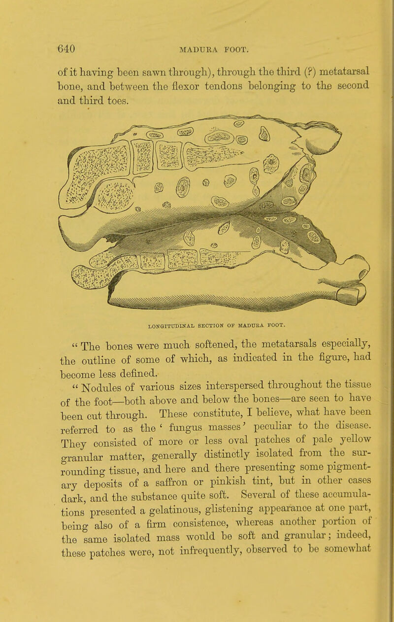 of it having been sawn tlirough), through the third (?) metatarsal bone, and between the flexor tendons belonging to the second and third toes. LONGITUDINAL SECTION OF MADURA FOOT.  The bones were much softened, the metatarsals especially, the outline of some of which, as indicated in the figure, had become less defined.  Nodules of various sizes interspersed throughout the tissue of the foot—both above and below the bones—are seen to have been cut through. These constitute, I believe, what have been referred to as the ' fungus masses' peculiar to the disease. They consisted of more or less oval patches of pale yeUow granular matter, generally distinctly isolated from the sur- rounding tissue, and here and there presenting some pigment- ary deposits of a saffron or pinkish tint, but in other cases dark, and the substance quite soft. Several of these accumula- tions' presented a gelatinous, glistening appearance at one pai-t, being also of a firm consistence, whereas another portion of the same isolated mass would be soft and granulai'; indeed, these patches were, not infrequently, observed to be somewhat