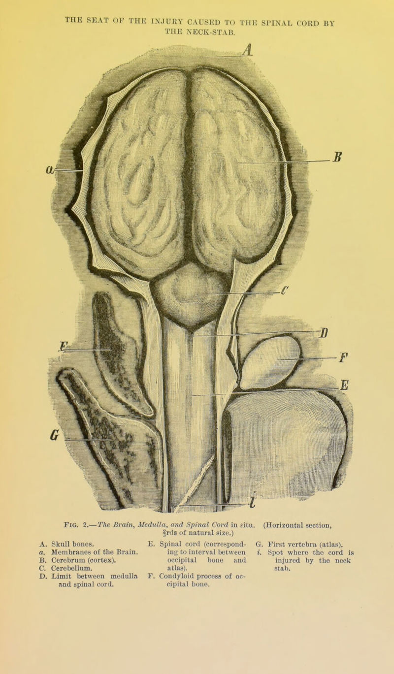 THE NECK-STAB. Fig. 2.—The Brain, Medulla, and Spinal Cord in eitu. (Horizontal section, 'jr<\s of natural size.) E. Spinal cord (correspond- G. First vertebra (atlas), lng to interval between i. Spot where the cord is occipital bone and injured by the neck atlas). slab. A. Skull bones. a. Membranes of the Brain B. Cerebrum (cortex). C. Cerebellum. D. Limit between medulla F. Condyloid process of oc- and spinal cord. cipital bone.