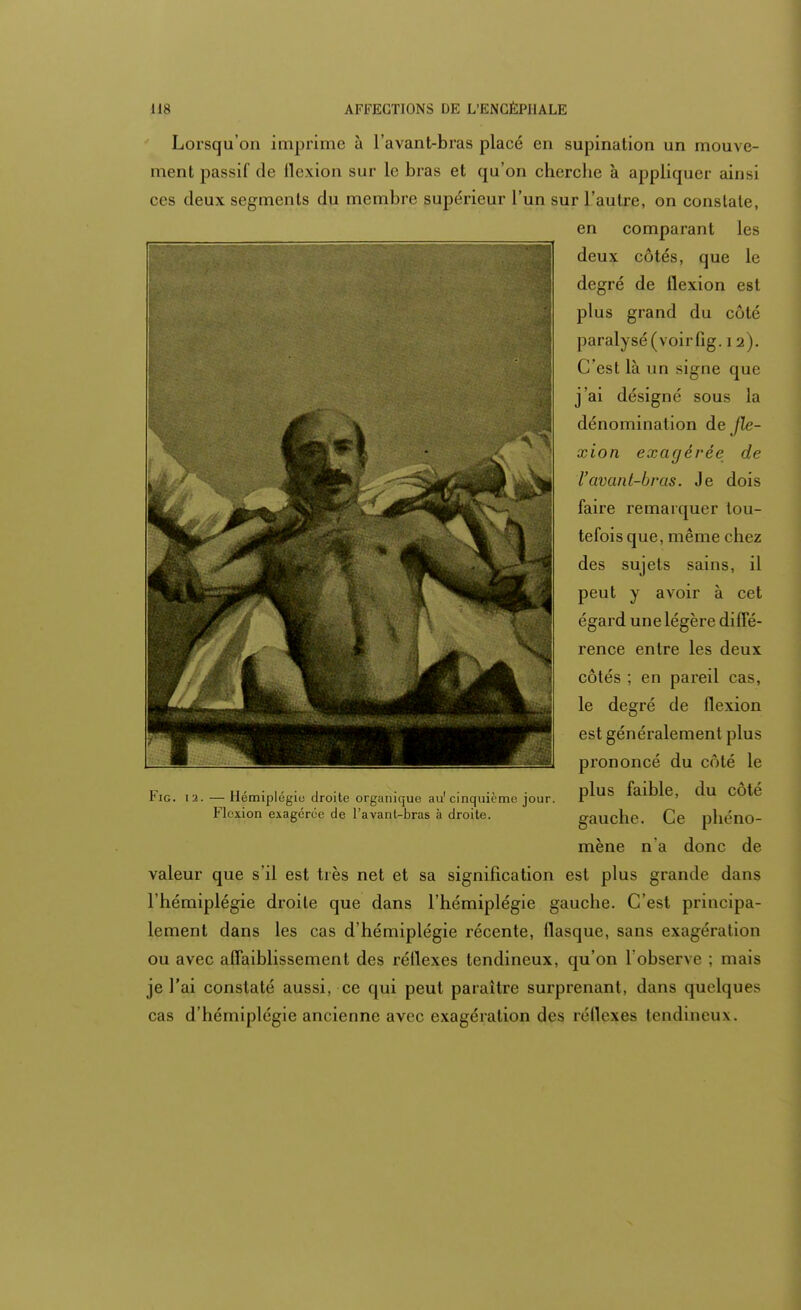 Lorsqu'on imprime à l'avant-bras placé en supination un mouve- ment passif de flexion sur le bras et qu'on cherche à appliquer ain-l ces deux segments du membre supérieur l'un sur l'autre, on conslale, en comparant les deux côtés, que le degré de flexion est plus grand du côté paralysé (voirfig. 12). C'est là un signe que j'ai désigné sous la dénomination de fle- xion exagérée de l'avant-bras. Je dois faire remarquer tou- tefois que, même chez des sujets sains, il peut y avoir à cet égard une légère diffé- rence entre les deux côtés ; en pareil cas, le degré de flexion est généralement plus prononcé du côté le plus faible, du côté gauche. Ce phéno- mène n'a donc de valeur que s'il est très net et sa signification est plus grande dans l'hémiplégie droite que dans l'hémiplégie gauche. C'est principa- lement dans les cas d'hémiplégie récente, flasque, sans exagération ou avec affaiblissement des réflexes tendineux, qu'on l'obseçve : mais je l'ai constaté aussi, ce qui peut paraître surprenant, dans quelques cas d'hémiplégie ancienne avec exagération des réflexes tendineux. Fie. 12. — Hémiplégie droite organique au'cinquième jour. Flexion exagérée de l'avant-bras à droite.