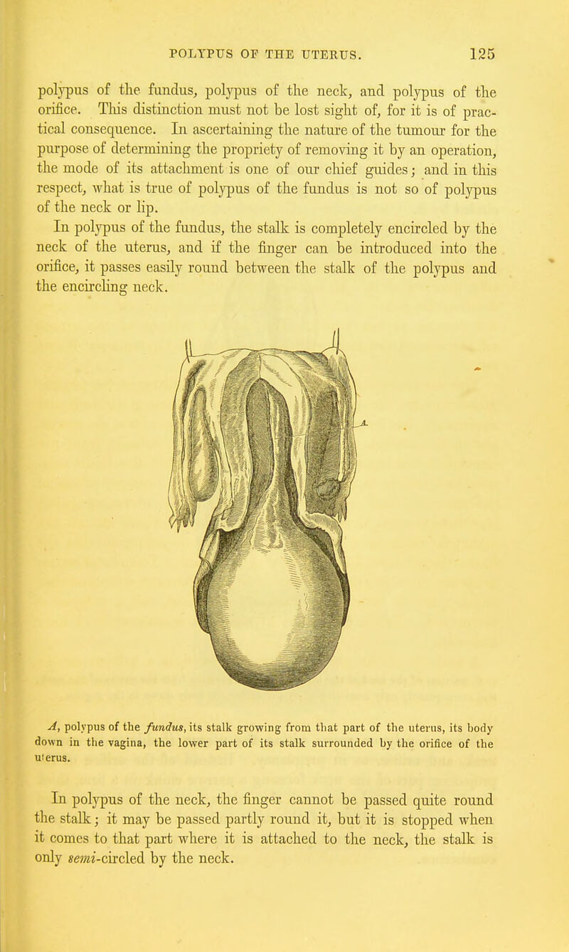 polypus of the fundus, polypus of the neck, and polypus of the orifice. Tliis distinction must not be lost sight of, for it is of prac- tical consequence. In ascertaining the nature of the tumour for the purpose of determining the propriety of removing it by an operation, the mode of its attachment is one of our chief guides; and in this respect, what is true of poljrpus of the fundus is not so of polypus of the neck or lip. In polypus of the fundus, the stalk is completely encircled by the neck of the uterus, and if the fmger can be introduced into the orifice, it passes easily round between the stalk of the polypus and the encircling neck. A, polypus of the fundus, its stalk growing from that part of the uterus, its body down in the vagina, the lower part of its stalk surrounded by the orifice of the uierus. In polypus of the neck, the finger cannot be passed quite round the stalk; it may be passed partly round it, but it is stopped when it comes to that part where it is attached to the neck, the stalk is only smi-circled by the neck.