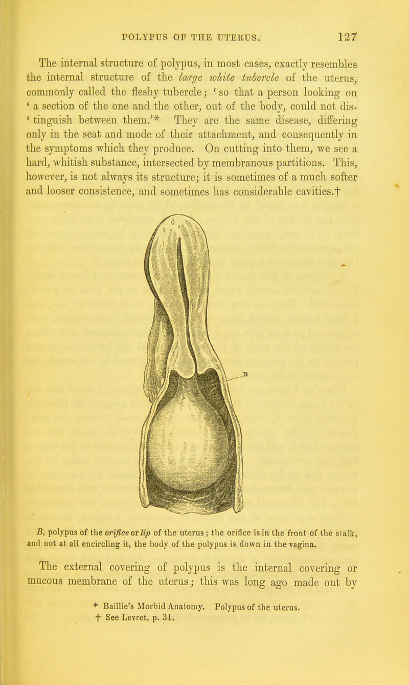The internal structure of polypus, in most cases, exactly resembles the internal structure of the large white tubercle of the uterus, conunonly called the fleshy tubercle; ' so that a person looking on ' a section of the one and the other, out of the body, could not dis- ' tinguish between them/* They are the same disease, differing only in the seat and mode of their attachment, and consequently in the symptoms which they produce. On cutting into them, we see a hard, whitish substance, intersected by membranous partitions. This, however, is not always its structure; it is sometimes of a much softer and looser consistence, and sometimes has considerable cavities.f B, polypus of the orifice or lip of the uterus; the orifice is in the front of the slalk, and not at all encircling it, the body of the polypus is down in the vagina. The external covering of polypus is the internal covering or mucous membrane of the uterus; tliis was long ago made out by * Baillie's Morbid Anatomy. Polypus of the uterus, t See Levret, p. 31.