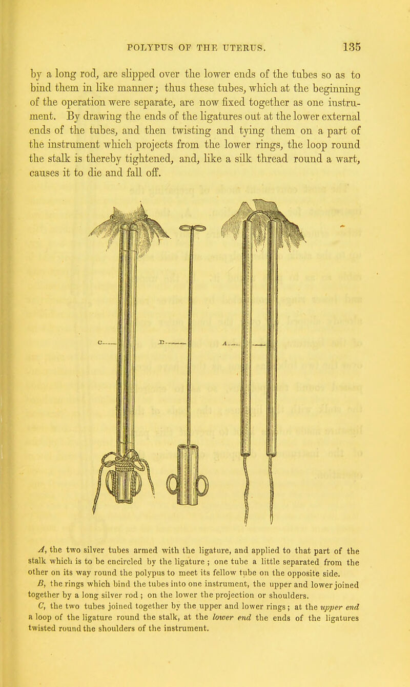 by a long rod, are slipped over tlie lower ends of the tubes so as to bind them in Hke manner; thus these tubes, which at the beginning of the operation were separate, are now fixed together as one instru- ment. By drawing the ends of the ligatures out at the lower external ends of the tubes, and then twisting and tying them on a part of the instrument which projects from the lower rings, the loop round the stalk is thereby tightened, and, like a silk thread round a wart, causes it to die and fall off. A, the two silver tubes armed with the ligature, and applied to that part of the stalk which is to be encircled by the ligature ; one tube a little separated from the other on its way round the polypus to meet its fellow tube on the opposite side. B, the rings which bind the tubes into one instrument, the upper and lower joined together by a long silver rod; on the lower the projection or shoulders. C, the two tubes joined together by the upper and lower rings; at the upper end a loop of the ligature round the stalk, at the lower end the ends of the ligatures twisted round the shoulders of the instrument.