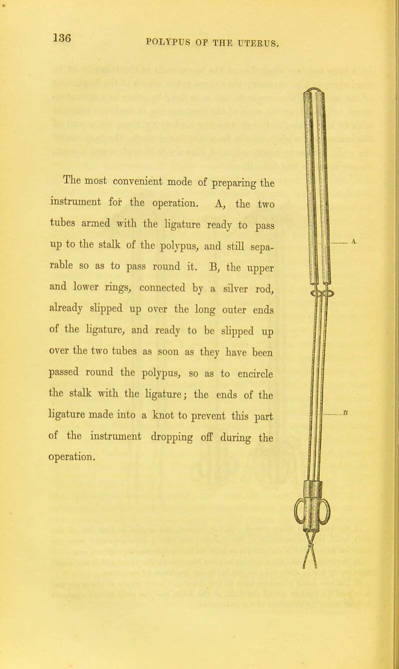POLYPUS OF THE UTERUS. The most convenient mode of preparing the instrument for the operation. A, the two tubes armed with the ligature ready to pass up to the stalk of the polypus, and still sepa- rable so as to pass round it. B, the upper and lower rings, connected by a silver rod, ah-eady slipped up over the long outer ends of the ligature, and ready to be sHpped up over the two tubes as soon as they have been passed round the polypus, so as to encircle the stalk with the ligature; the ends of the ligature made into a knot to prevent this part of the instrument dropping off during the operation.