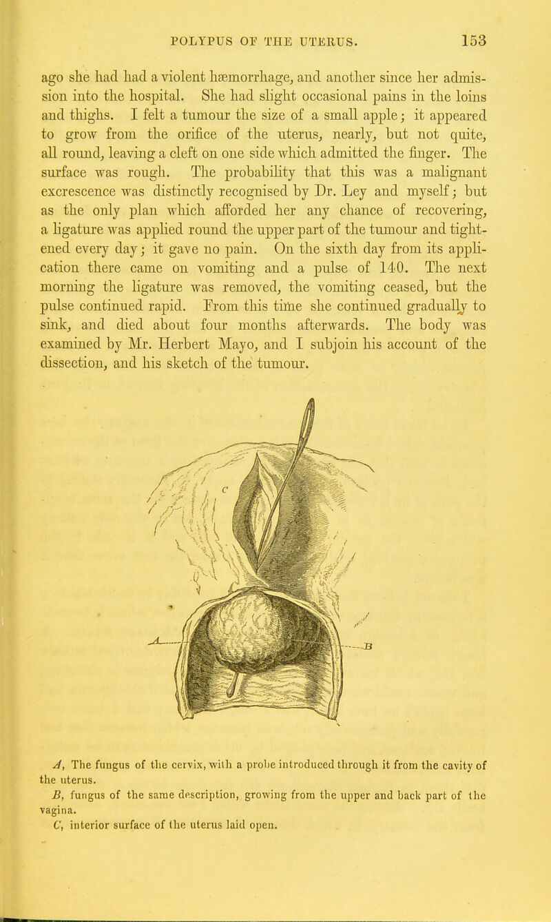 ago she had had a violent hcKmorrhage, and another since her admis- sion into the hospital. She had slight occasional pains in the loins and thighs. I felt a tumour the size of a small apple; it appeared to grow from the orifice of the uterus, nearly, but not quite, all round, leaving a cleft on one side wliich admitted the finger. The surface was rough. The probability that this was a malignant excrescence was distinctly recognised by Dr. Ley and myself; but as the only plan which afforded her any chance of recovering, a ligature was applied round the upper part of the tumour and tight- ened every day; it gave no pain. On the sixth day from its appli- cation there came on vomiting and a pulse of 140. The next morning the ligature was removed, the vomiting ceased, but the pulse continued rapid. From this time she continued gradually to sink, and died about four months afterwards. The body was examined by Mr. Herbert Mayo, and I subjoin his account of the dissection, and his sketch of the tumour. J, The fungus of the cervix, with a prolie introduced through it from the cavity of the uterus. B, fungus of the same description, growing from the upper and back part of the vagina. C, interior surface of the uterus laid open.