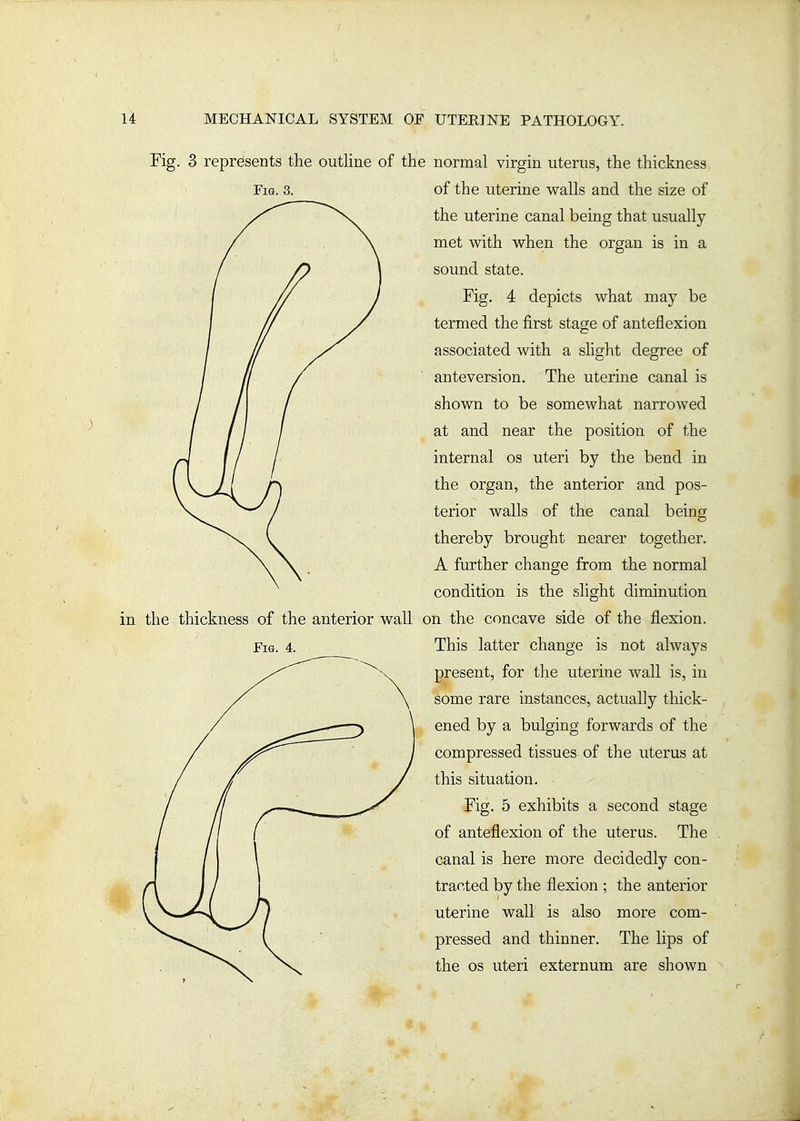 Fig. 3 represents the outline of th Fig. 3. in the thickness of the anterior wall Fig. 4. e normal virgin uterus, the thickness of the uterine walls and the size of the uterine canal being that usually met with when the organ is in a sound state. Fig. 4 depicts what may be termed the first stage of anteflexion associated with a slight degree of anteversion. The uterine canal is shown to be somewhat narrowed at and near the position of the internal os uteri by the bend in the organ, the anterior and pos- terior walls of the canal being thereby brought nearer together. A further change from the normal condition is the slight diminution on the concave side of the flexion. This latter change is not always present, for the uterine wall is, in some rare instances, actually thick- ened by a bulging forwards of the compressed tissues of the uterus at this situation. Fig. 5 exhibits a second stage of anteflexion of the uterus. The canal is here more decidedly con- tracted by the flexion ; the anterior uterine wall is also more com- pressed and thinner. The lips of the OS uteri externum are shown