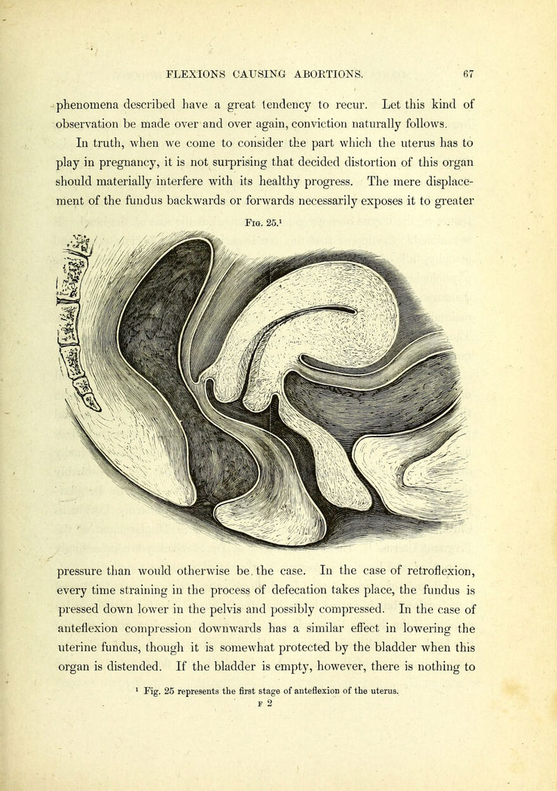 phenomena described have a great tendency to recur. Let this kind of observation be made over and over again, conviction naturally follows. In truth, when we come to consider the part which the uterus has to play in pregnancy, it is not surprising that decided distortion of this organ should materially interfere with its healthy progress. The mere displace- ment of the fundus backwards or forwards necessarily exposes it to greater Fig. 25.1 pressure than would otherwise be. the case. In the case of retroflexion, every time straining in the process of defecation takes place, the fundus is pressed down lower in the pelvis and possibly compressed. In the case of anteflexion compression downwards has a similar efiect in lowering the uterine fundus, though it is somewhat protected by the bladder when this organ is distended. If the bladder is empty, however, there is nothing to