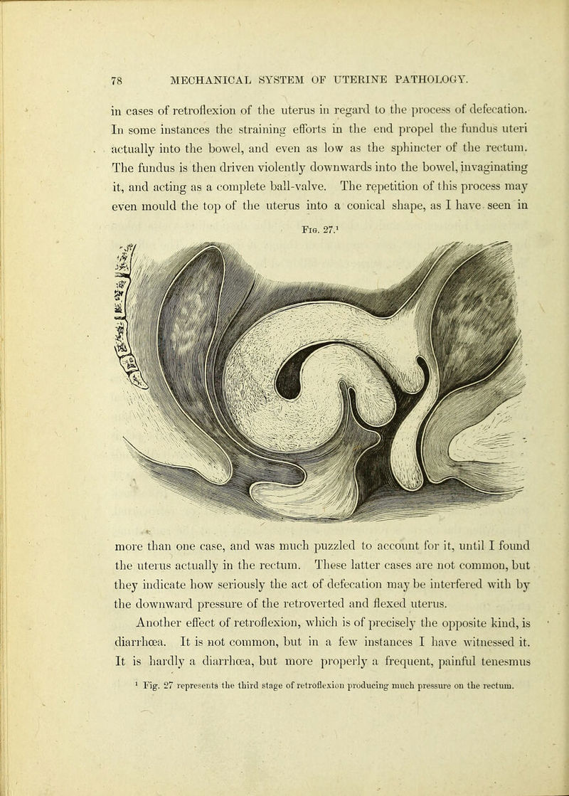 in cases of retroflexion of the uterus in regard to tlie process of defecation.- In some instances the straining efforts in the end propel the fundus uteri actually into the bowel, and even as low as the sphincter of the rectum. The fundus is then driven violently downwards into the bowel, invaginating it, and acting as a complete ball-valve. The repetition of this process may even mould the top of the uterus into a conical shape, as I have -seen in Fig. 27.1 more than one case, and was much puzzled to accoimt for it, until I found the uterus actually in the rectum. These latter cases are not common, but they indicate how seriously the act of defecation maybe interfered with by the downward pressure of the retroverted and flexed uterus. Another effect of retroflexion, which is of precisely the opposite kind, is diarrhcBa. It is not common, but in a few instances I have witnessed it. It is hardly a diarrhoea, but more properly a frequent, painful tenesmus ' Fig. 27 represents the tliird stage of retroflexion produciug much pressure ou the rectum.