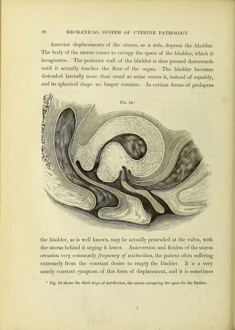Anterior displacements of the uterus, as a rule, depress the bladder. The body of the uterus comes to occupy the space of the bladder, which it invaginates. The posterior wall of the bladder is thus pressed downwards until it actually touches the floor of the organ. The bladder becomes distended laterally more than usual as urine enters it, instead of equably, and its spherical shape no longer remains. In certain forms of prolapsus the bladder, as is well known, may be actually protruded at the vulva, with the uterus behind it urging it lower. Anteversion and flexion of the uterus occasion very commonly frequency of micturition, the patient often suffering extremely from the constant desire to empty the bladder. It is a very nearly constant symptom of this form of displacement, and it is sometimes i 1 Fig. 28 shows the third stage of anteflexion, the uterus occupying the space for the bladder. i