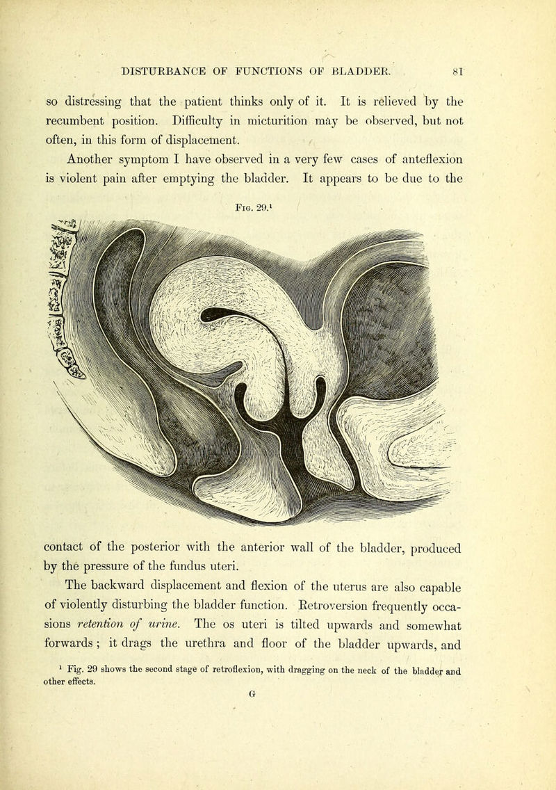 SO distressing that the patient thinks only of it. It is relieved by the recumbent position. Difficulty in micturition mdy be observed, but not often, in this form of displacement. Another symptom I have observed in a very few cases of anteflexion is violent pain after emptying the bladder. It appears to be due to the Fig. 29. > contact of the posterior with the anterior wall of the bladder, produced by the pressure of the fundus uteri. The backward displacement and flexion of the uterus are also capable of violently disturbing the bladder function. Eetroversion frequently occa- sions retention of urine. The os uteri is tilted upwards and somewhat forwards ; it drags the urethra and floor of the bladder upwards, and 1 Fig. 29 shows the second stage of retroflexion, with dragging on the neck of the bladder and other effects. G