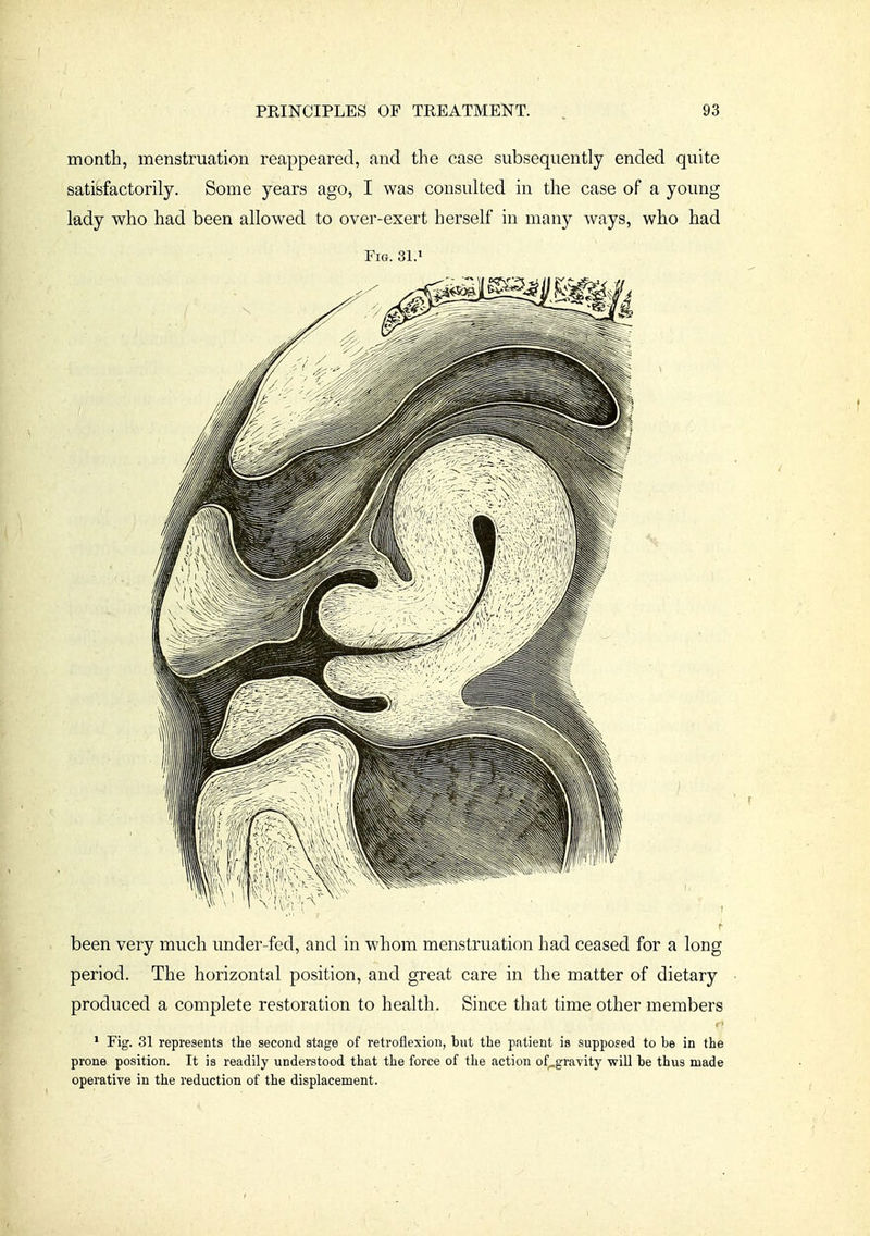 month, menstruation reappeared, and the case subsequently ended quite satisfactorily. Some years ago, I was consulted in the case of a young lady who had been allowed to over-exert herself in many ways, who had Fig. 31.1 been very much under-fed, and in whom menstruation had ceased for a long period. The horizontal position, and great care in the matter of dietary produced a complete restoration to health. Since that time other members ' Fig. 31 represents the second stage of retroflexion, tut tlie patient is supposed to be in the prone position. It is readily understood tbat tlie force of the action of^gravity will be thus made operative in the reduction of the displacement.
