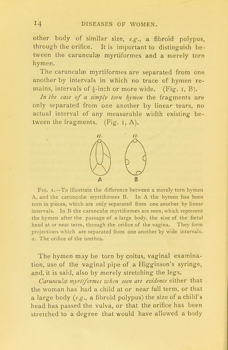 Other body of similar size, e.g., a fibroid polypus, through the orifice. It is important to distinguish be- tween the carunculae myrtiformes and a merely torn hymen. The carunculae myrtiformes are separated from one another by intervals in which no trace of hymen re- mains, intervals of i-inch or more wide. (Fig. i, B). In ihe case of a simply torn hymen the fragments are only separated from one another by linear tears, no actual interval of any measurable width existing be- tween the fragments. (Fig. i, A). 0 A B Fig. I.—To illustrate the difference between a merely torn hymen A, and the carunculae myrtiformes B. In A the hymen has been torn in pieces, which are only separated from one another by linear intervals. In B the carunculae myrtiformes are seen, which represent the hymen after the passage of a large body, the size of the foetal head at or near term, through the orifice of the vagina. They form projections which are separated from one another by wide intervals. a. The orifice of the urethra. The hymen may be torn by coitus, vaginal examina- tion, use of the vaginal pipe of a Higginson's syringe, and, it is said, also by merely stretching the legs. Carunculce myrliforvies when seen are evidence either that the woman has had a child at or near full term, or that a large body {e.g., a fibroid polypus) the size of a child's head has passed the vulva, or that the orifice has been stretched to a degree that would have allowed a body