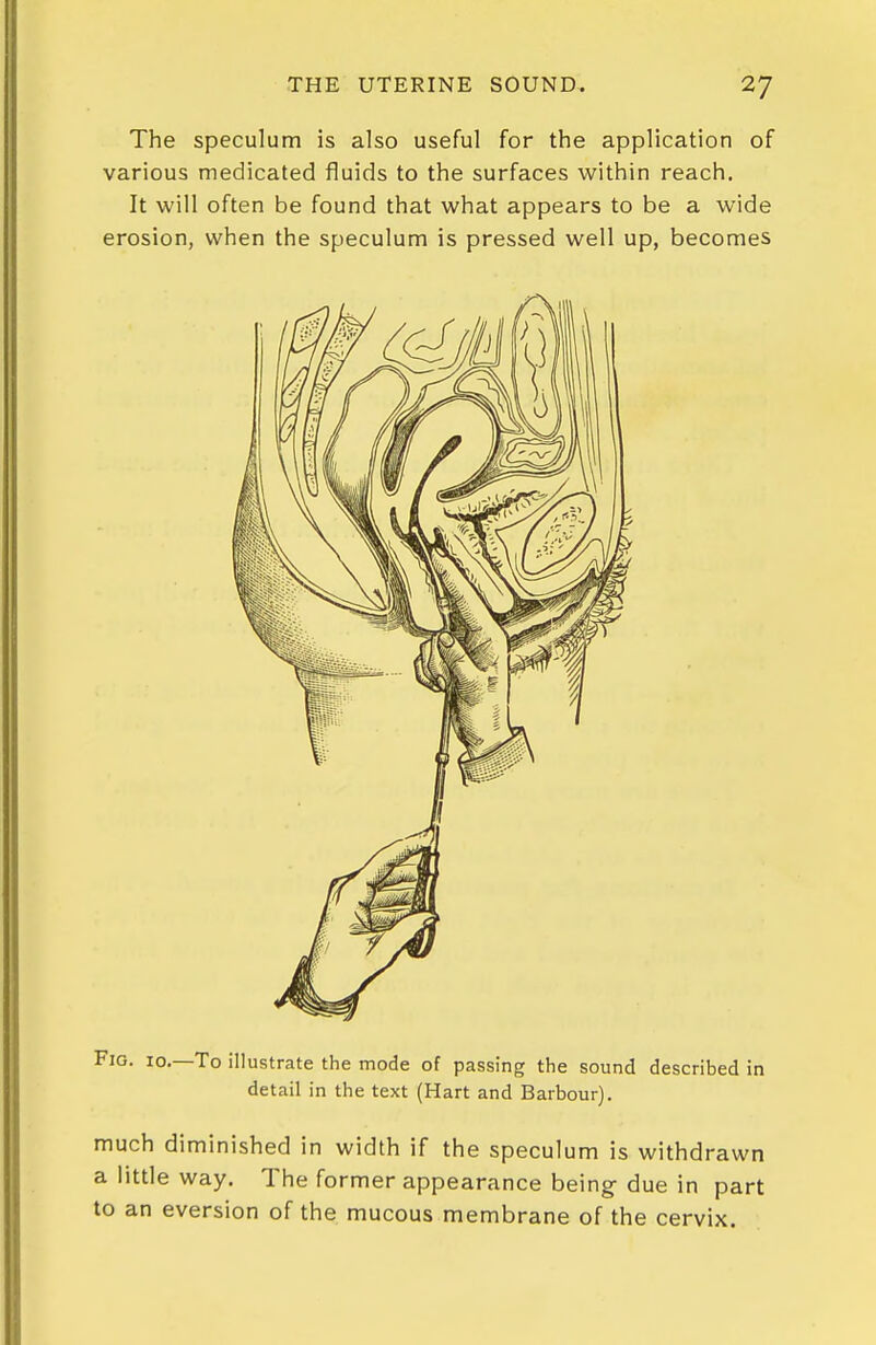 The speculum is also useful for the application of various medicated fluids to the surfaces within reach. It will often be found that what appears to be a wide erosion, when the speculum is pressed well up, becomes Fig. 10.—To illustrate the mode of passing the sound described in detail in the text (Hart and Barbour). much diminished in width if the speculum is withdrawn a little way. The former appearance being- due in part to an eversion of the mucous membrane of the cervix.