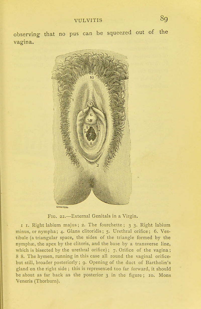 observing- that no pus can be squeezed out of vagina. Fig. 22.—External Genitals in a Virgin. I I. Right labium majus; 2. The fourchette ; 3 3. Right labium minus, or nympha; 4. Glans clitoridis; 5. Urethral orifice; 6. Ves- tibule (a triangular space, the sides of the triangle formed by the nymphffi, the apex by the clitoris, and the base by a transverse line, which is bisected by the urethral orifice); 7. Orifice of the vagina; 8 8. The hymen, running in this case all round the vaginal orificei but still, broader posteriorly ; 9. Opening of the duct of Bartholin's gland on the right side ; this is represented too far forward, it should be about as far back as the posterior 3 in the figure; 10. Mens Veneris (Thorburn).