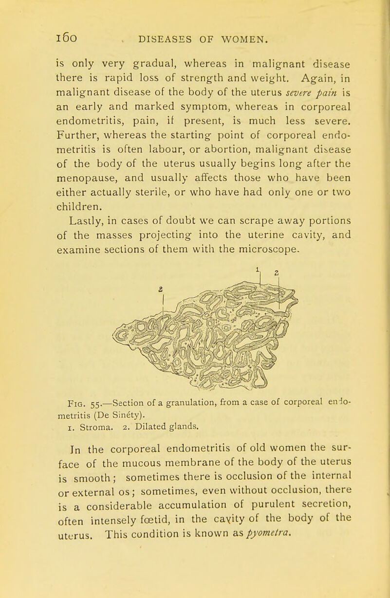 i6o is only very gradual, whereas in malignant disease there is rapid loss of strength and weight. Again, in malignant disease of the body of the uterus sevtre pain is an early and marked symptom, whereas in corporeal endometritis, pain, if present, is much less severe. Further, whereas the starting point of corporeal endo- metritis is often labour, or abortion, malignant disease of the body of the uterus usually begins long after the menopause, and usually affects those who have been either actually sterile, or who have had only one or two children. Lastly, in cases of doubt we can scrape av/ay portions of the masses projecting into the uterine cavity, and examine sections of them with the microscope. Fig. 55.—Section of a granulation, from a case of corporeal en-Jo- metritis (De Sinety). I. Stroma. 2. Dilated glands. In the corporeal endometritis of old women the sur- face of the mucous membrane of the body of the uterus is smooth; sometimes there is occlusion of the internal or external os ; sometimes, even without occlusion, there is a considerable accumulation of purulent secretion, often intensely foetid, in the cayity of the body of the uterus. This condition is known as pyomeira.