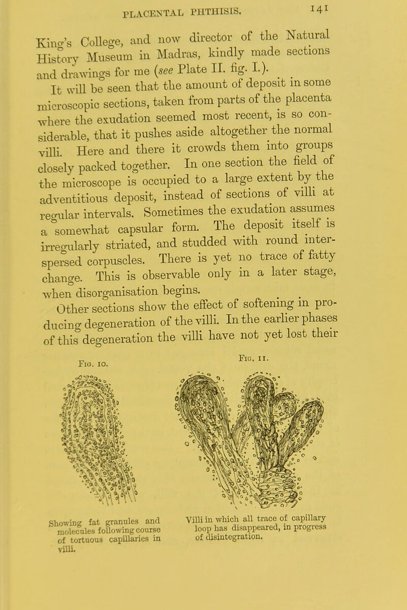 Kino-'s College, and now director of the Natural History Museum in Madras, kindly made sections and drawings for me (see Plate II. fig I.). _ It will be seen that the amount of deposit m some microscopic sections, taken from parts of the placenta where the exudation seemed most recent, is so con- siderable, that it pushes aside altogether the normal villi Here and there it crowds them into groups closely packed together. In one section the field of the microscope is occupied to a large extent by the adventitious deposit, instead of sections of villi at regular intervals. Sometimes the exudation assumes a Somewhat capsular form. The deposit itself is irregularly striated, and studded with round inter- spersed corpuscles. There is yet no trace of fatty change. This is observable only in a later stage, when disorganisation begins. Other sections show the effect of softening m pro- ducing degeneration of the villi. In the earlier phases of this degeneration the villi have not yet lost their Fig. 10. Fig. 11. wEBk Showing fat granules and molecules following course of tortuous capillaries in villi. Villi in which all trace of capillary loop has disappeared, in progress of disintegration.