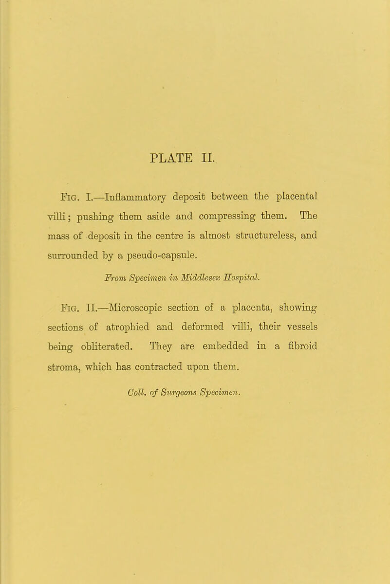 Fig. I.—Inflammatory deposit between the placental villi; pushing them aside and compressing them. The mass of deposit in the centre is almost structureless, and surrounded by a pseudo-capsule. From Specimen in Middlesex, Hospital. Fig. XL—Microscopic section of a placenta, showing sections of atrophied and deformed villi, their vessels being obliterated. They are embedded in a fibroid stroma, which has contracted upon them. Coll. of Siirgeons Specimen.