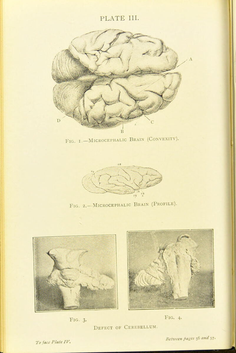 r Yic. I.—Microcephalic Brain (Convexity). Fig. 2.—Microcephalic Brain (Profile). Fig. 3. Fig. 4. Defect of Cerebellum. Tff face Plate IV. Between fagcs 56 and