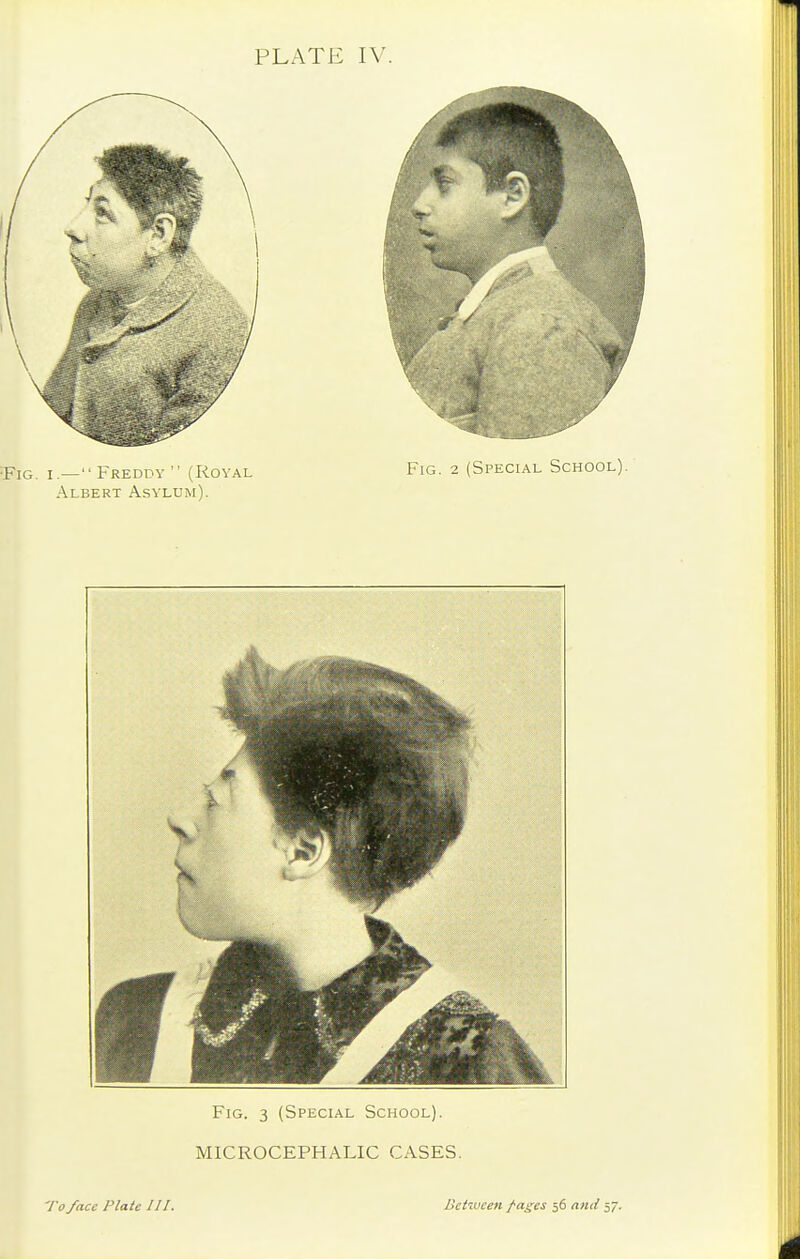 •Fig. I.—Freddy  (Royal Fig. 2 (Special School). Albert Asylum).