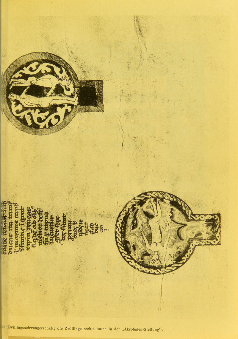 J Zwillingsschwangerschaft; die Zwillinge rechts unten In der „Akrobaten-Stellung.