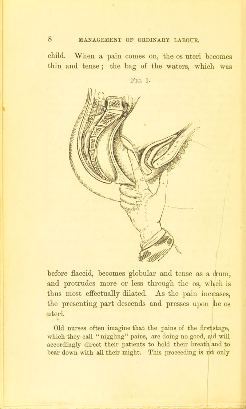 child. When a pain comes on, the os uteri becomes thin and tense; the bag of the •waters, which was Fig. 1. before flaccid, becomes globular and tense as a dnim, and protrudes more or less through the os, whch is thus most effectually dilated. As the pain incrsases, the presenting part descends and presses upon ihe os uteri. ] Old nurses often imagine that the pains of the first stage, whicli they call niggling paius, are doing no good, aid ■will accordingly direct their patients to hold their breath and to bear down with all their might. This proceeding is iBt only