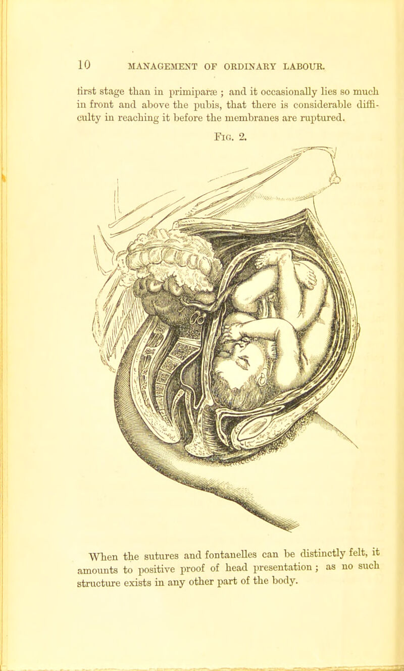 tirst stage than in primiparoe ; and it occasionally lies so much in front and above the pubis, that there is considerable diffi- culty in reaching it before the membranes are ruptured. Fir;. 2. Wlien the sutures and fontaneUes can be distinctly felt, it amounts to positive proof of head presentation ; as no such structure exists in any other part of the body.