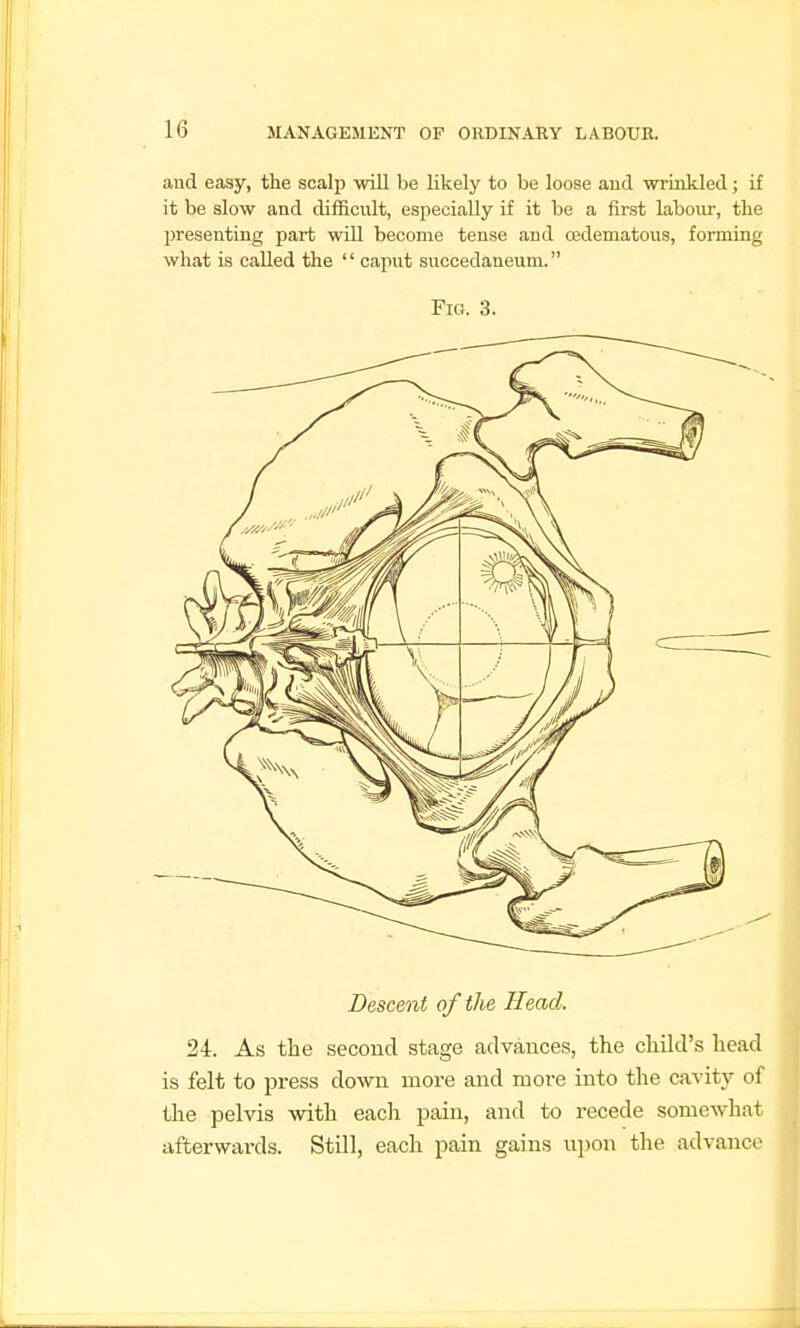 and easy, the scalj) will be likely to be loose and wrinkled; if it be slow and difficult, especially if it be a first labour, the presenting part will become tense and cfidematous, forming what is called the '' caput succedaneum. Fig. 3. Descent of the Head. 24. As the second stage advances, the child's head is felt to press down more and more into the cavity of the pelvis with each pain, and to recede somewhat afterwards. Still, each pain gains npon the advance