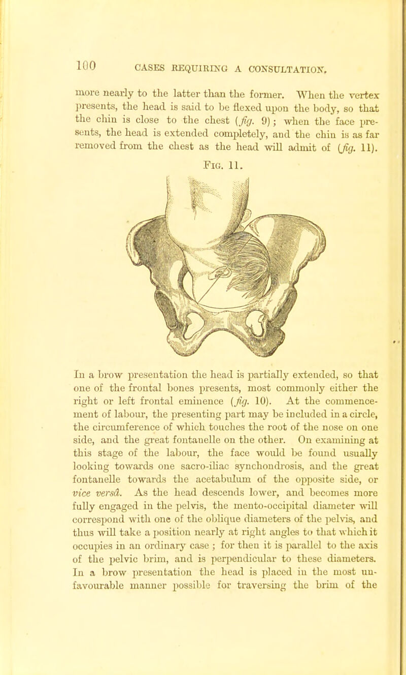 lOO more nearly to tlie latter than the former. When the vertex ]iresents, the head is said to be flexed upon the body, so that the chin is close to the chest (fuj. 9); when the face pre- stmts, the head is extended completely, and the chin is as far removed from the chest as the head will admit of (Ji<j. 11). In a brow presentation the head is partially extended, so that one of the frontal bones presents, most commonly either the right or left frontal eminence (Jig. 10). At the commence- ment of labour, the j)resenting part may be included in a circle, the circumference of which touches the root of the nose on one side, and the great fontauelle on the other. On examining at this stage of the labour, the face woidd be foimd usually looking towards one sacro-iUac synchondi-osis, and the great fontauelle towards the acetabulum of the opposite side, or vice versd. As the head descends lower, and becomes more fully engaged in the pelvis, the meuto-occipital lUameter will correspond with one of the oblique diameters of the pelvis, and thus will take a j)osition nearly at right angles to that which it occupies in an ordinary case ; for then it is jiarallel to the axis of the pelvic brim, and is iierpendicular to these diameters. In a brow presentation the head is placed in the most un- favourable manner possible for traversing the brim of the Fici. 11.