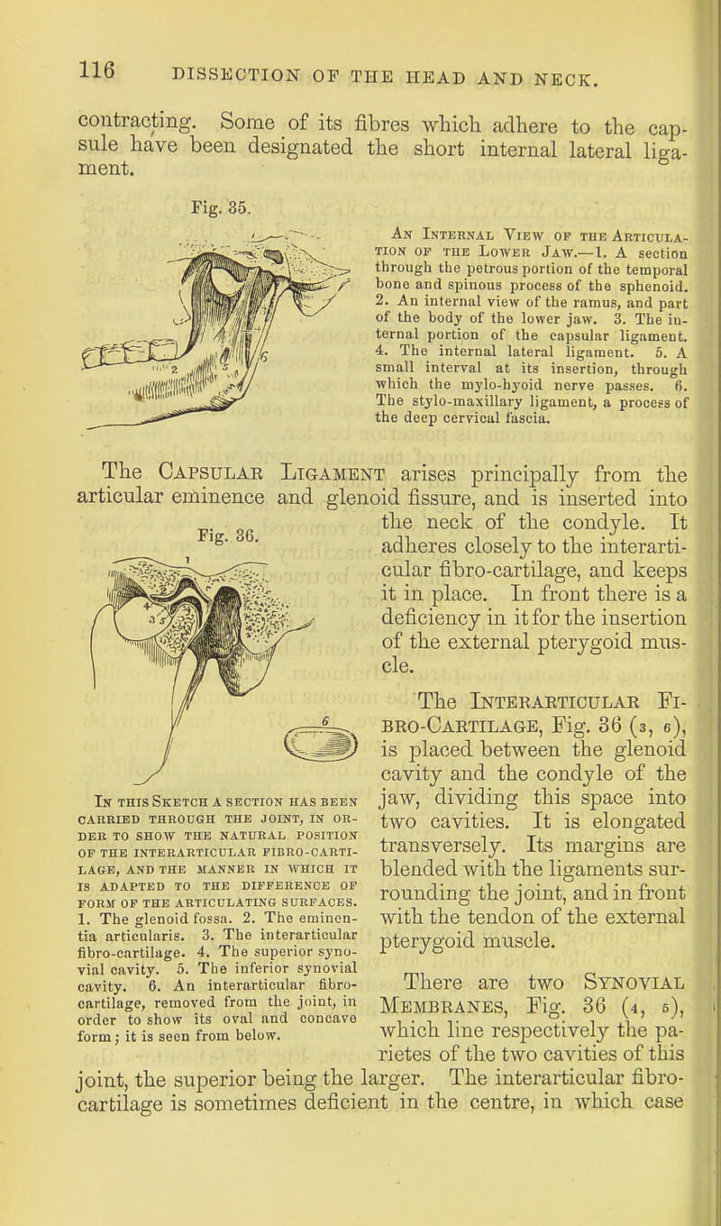 contracting. Some of its fibres which adhere to the cap- sule have been designated the short internal lateral liga- ment. Fig. 35. An Internal View op the Articula- tion OP TUB LowEK Jaw.—I. A section through the petrous portion of the temporal bono and spinous process of the sphenoid. 2. An internal view of the ramus, and part of the body of the lower jaw. 3. The in- ternal portion of the capsular ligament. 4. The internal lateral ligament. 5. A small interval at its insertion, through which the mylo-hj'oid nerve passes. 6. The stylo-maxillary ligament, a process of the deep cervical fascia. Fig. 36. The Capsular Ligament arises principally from the articular eminence and glenoid fissure, and is inserted into the neck of the condyle. It adheres closely to the interarti- cular fibro-cartilage, and keeps it in place. In front there is a deficiency in it for the insertion of the external pterygoid mus- cle. The Interaeticular Fi- bro-Cartilage, Fig. 36 (3, e), is placed between the glenoid cavity and the condyle of the jaw, dividing this space into two cavities. It is elongated transversely. Its margins are blended with the ligaments sur- rounding the joint, and in front with the tendon of the external pterygoid muscle. In this Sketch a section has been carried through the joint, in or- der to show the natural position of the interarticular fibro-carti- lage, and the manner in which it is adapted to the difference op form op the articulating surfaces. 1. The glenoid fossa. 2. The eminon- tia articularis. 3. The interarticular fibro-cartilage. 4. The superior syno- vial cavity. 5. The inferior synovial cavity. 6. An interarticular fibro- cartilage, removed from the joint, in order to show its oval and concave form; it is seen from below. There are two Synovial Membranes, Fig. 36 (4, 5), which line respectively the pa- rietes of the two cavities of this joint, the superior being the larger. The interarticular fibro- cartilage is sometimes deficient in the centre, in Avhich case