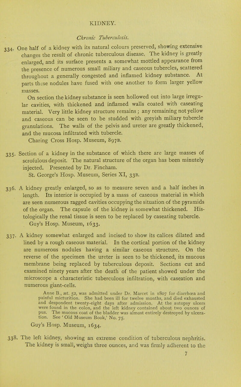 Chronic Tuberculosis. 334. One half of a kidney with its natural colours preserved, showing extensive changes the result of chronic tuberculous disease. The kidney is greatly enlarged, and its surface presents a somewhat mottled appearance from the presence of numerous small miliary and caseous tubercles, scattered throughout a generally congested and inflamed kidney substance. At parts these nodules have fused with one another to form larger yellow masses. On section the kidney substance is seen hollowed out into large irregu- lar cavities, with thickened and inflamed walls coated with caseating material. Very little kidney structure remains; any remaining not yellow and caseous can be seen to be studded with greyish miliary tubercle granulations. The walls of the pelvis and ureter are greatly thickened, and the mucosa infiltrated with tubercle. Charing Cross Hosp. Museum, 897B. 335. Section of a kidney in the substance of which there are large masses of scrofulous deposit. The natural structure of the organ has been minutely injected. Presented by Dr, Fincham. St. George’s Hosp. Museum, Series XI, 33B. 336. A kidney greatly enlarged, so as to measure seven and a half inches in length. Its interior is occupied by a mass of caseous material in which are seen numerous ragged cavities occupying the situation of the pyramids of the organ. The capsule of the kidney is somewhat thickened. His- tologically the renal tissue is seen to be replaced by caseating tubercle. Guy’s Hosp. Museum, 1633. 337. A kidney somewhat enlarged and incised to show its calices dilated and lined by a rough caseous material. In the cortical portion of the kidney are numerous nodules having a similar caseous structure. On the reverse of the specimen the ureter is seen to be thickened, its mucous membrane being replaced by tuberculous deposit. Sections cut and examined ninety years after the death of the patient showed under the microscope a characteristic tuberculous infiltration, with caseation and numerous giant-cells. Anne B., set. 52, was admitted under Dr. Marcet in 1807 for diarrhoea and painful micturition. She had been ill for twelve months, and died exhausted and despondent twenty-eight days after admission. At the autopsy ulcers were found in the colon, and the left kidney contained about two ounces of pus. The mucous coat of the bladder was almost entirely destroyed by ulcera- tion. See ' Old Museum Book,’ No. 75. Guy’s Hosp. Museum, 1634. 338. The left kidney, showing an extreme condition of tuberculous nephritis. The kidney is small, weighs three ounces, and was firmly adherent to the 7