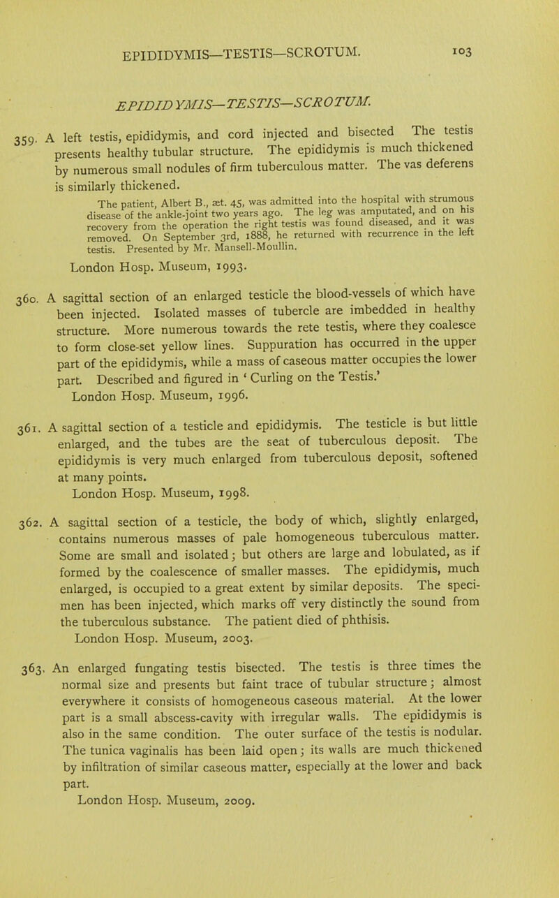 EPIDID YM1S— TESTIS— SCROTUM. 359’ A left testis, epididymis, and cord injected and bisected The testis presents healthy tubular structure. The epididymis is much thickened by numerous small nodules of firm tuberculous matter. The vas deferens is similarly thickened. The patient, Albert B., set. 45, was admitted into the hospital with strumous disease of the ankle-joint two years ago. The leg was amputated, and on his recovery from the operation the right testis was found diseased, and it was removed. On September 3rd, 1888, he returned with recurrence in the left testis. Presented by Mr. Mansell-Moullin. London Hosp. Museum, 1993. 360. A sagittal section of an enlarged testicle the blood-vessels of which have been injected. Isolated masses of tubercle are imbedded in healthy structure. More numerous towards the rete testis, where they coalesce to form close-set yellow lines. Suppuration has occurred in the upper part of the epididymis, while a mass of caseous matter occupies the lower part. Described and figured in ‘ Curling on the Testis.’ London Hosp. Museum, 1996. 361. A sagittal section of a testicle and epididymis. The testicle is but little enlarged, and the tubes are the seat of tuberculous deposit. The epididymis is very much enlarged from tuberculous deposit, softened at many points. London Hosp. Museum, 1998. 362. A sagittal section of a testicle, the body of which, slightly enlarged, contains numerous masses of pale homogeneous tuberculous matter. Some are small and isolated; but others are large and lobulated, as if formed by the coalescence of smaller masses. The epididymis, much enlarged, is occupied to a great extent by similar deposits. The speci- men has been injected, which marks off very distinctly the sound from the tuberculous substance. The patient died of phthisis. London Hosp. Museum, 2003. 363. An enlarged fungating testis bisected. The testis is three times the normal size and presents but faint trace of tubular structure; almost everywhere it consists of homogeneous caseous material. At the lower part is a small abscess-cavity with irregular walls. The epididymis is also in the same condition. The outer surface of the testis is nodular. The tunica vaginalis has been laid open; its walls are much thickened by infiltration of similar caseous matter, especially at the lower and back part. London Hosp. Museum, 2009.