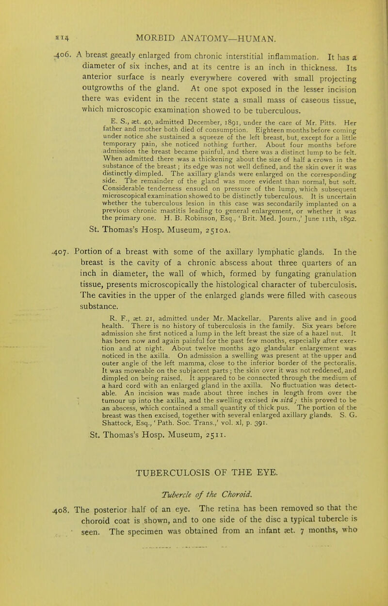 406. A breast greatly enlarged from chronic interstitial inflammation. It has a diameter of six inches, and at its centre is an inch in thickness. Its anterior surface is nearly everywhere covered with small projecting outgrowths of the gland. At one spot exposed in the lesser incision there was evident in the recent state a small mass of caseous tissue, which microscopic examination showed to be tuberculous. E. S., at. 40, admitted December, 1891, under the care of Mr. Pitts. Her father and mother both died of consumption. Eighteen months before coming under notice she sustained a squeeze of the left breast, but, except for a little temporary pain, she noticed nothing further. About four months before admission the breast became painful, and there was a distinct lump to be felt. When admitted there was a thickening about the size of half a crown in the substance of the breast; its edge was not well defined, and the skin over it was distinctly dimpled. The axillary glands were enlarged on the corresponding side. The remainder of the gland was more evident than normal, but soft. Considerable tenderness ensued on pressure of the lump, which subsequent microscopical examination showed to be distinctly tuberculous. It is uncertain whether the tuberculous lesion in this case was secondarily implanted on a previous chronic mastitis leading to general enlargement, or whether it was the primary one. H. B. Robinson, Esq., ' Brit. Med. Journ.,’ June 11th, 1892. St. Thomas’s Hosp. Museum, 2510A. .407. Portion of a breast with some of the axillary lymphatic glands. In the breast is the cavity of a chronic abscess about three quarters of an inch in diameter, the wall of which, formed by fungating granulation tissue, presents microscopically the histological character of tuberculosis. The cavities in the upper of the enlarged glands were filled with caseous substance. R. F., set. 21, admitted under Mr. Mackellar. Parents alive and in good health. There is no history of tuberculosis in the family. Six years before admission she first noticed a lump in the left breast the size of a hazel nut. It has been now and again painful for the past few months, especially after exer- tion and at night. About twelve months ago glandular enlargement was noticed in the axilla. On admission a swelling was present at the upper and outer angle of the left mamma, close to the inferior border of the pectoralis. It was moveable on the subjacent parts ; the skin over it was not reddened, and dimpled on being raised. It appeared to be connected through the medium of a hard cord with an enlarged gland in the axilla. No fluctuation was detect- able. An incision was made about three inches in length from over the tumour up into the axilla, and the swelling excised in situ ; this proved to be an abscess, which contained a small quantity of thick pus. The portion of the breast was then excised, together with several enlarged axillary glands. S. G. Shattock, Esq., ‘ Path. Soc. Trans.,’ vol. xl, p. 391. St. Thomas’s Hosp. Museum, 2511. TUBERCULOSIS OF THE EYE. Tubercle of the Choroid. 408. The posterior half of an eye. The retina has been removed so that the choroid coat is shown, and to one side of the disc a typical tubercle is seen. The specimen was obtained from an infant set. 7 months, who