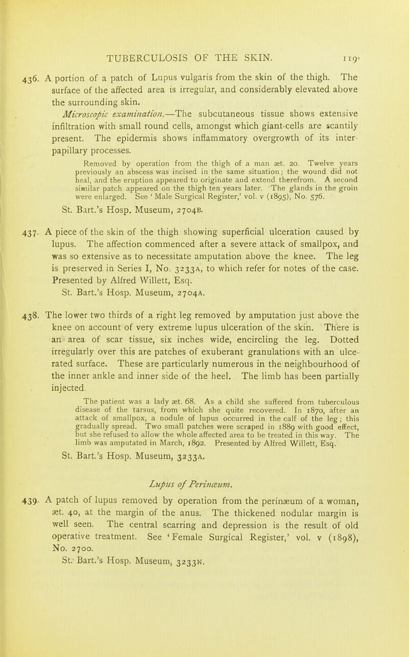 436. A portion of a patch of Lupus vulgaris from the skin of the thigh. The surface of the affected area is irregular, and considerably elevated above the surrounding skin. Microscopic examination.—The subcutaneous tissue shows extensive infiltration with small round cells, amongst which giant-cells are scantily present. The epidermis shows inflammatory overgrowth of its inter- papillary processes. Removed by operation from the thigh of a man set. 20. Twelve years previously an abscess was incised in the same situation; the wound did not heal, and the eruption appeared to originate and extend therefrom. A second similar patch appeared on the thigh ten years later. The glands in the groin were enlarged. See ‘ Male Surgical Register/ vol. v (1895), No. 576. St. Bart.’s Hosp. Museum, 2704B. 437. A piece of the skin of the thigh showing superficial ulceration caused by lupus. The affection commenced after a severe attack of smallpox, and was so extensive as to necessitate amputation above the knee. The leg is preserved in Series I, No. 3233A, to which refer for notes of the case. Presented by Alfred Willett, Esq. St. Bart.’s Hosp. Museum, 2704A. 438. The lower two thirds of a right leg removed by amputation just above the knee on account of very extreme lupus ulceration of the skin. There is an area of scar tissue, six inches wide, encircling the leg. Dotted irregularly over this are patches of exuberant granulations with an ulce- rated surface. These are particularly numerous in the neighbourhood of the inner ankle and inner side of the heel. The limb has been partially injected. The patient was a lady ast. 68. As a child she suffered from tuberculous disease of the tarsus, from which she quite recovered. In 1870, after an attack of smallpox, a nodule of lupus occurred in the calf of the leg; this gradually spread. Two small patches were scraped in 1889 with good effect, but she refused to allow the whole affected area to be treated in this way. The limb was amputated in March, 1892. Presented by Alfred Willett, Esq. St. Bart.’s Hosp. Museum, 3233A. Lupns of Perinaum. 439- A patch of lupus removed by operation from the perinaeum of a woman, set. 40, at the margin of the anus. The thickened nodular margin is well seen. The central scarring and depression is the result of old operative treatment. See ‘Female Surgical Register,’ vol. v (1898), No. 2700. St. Bart.’s Hosp. Museum, 3233N.