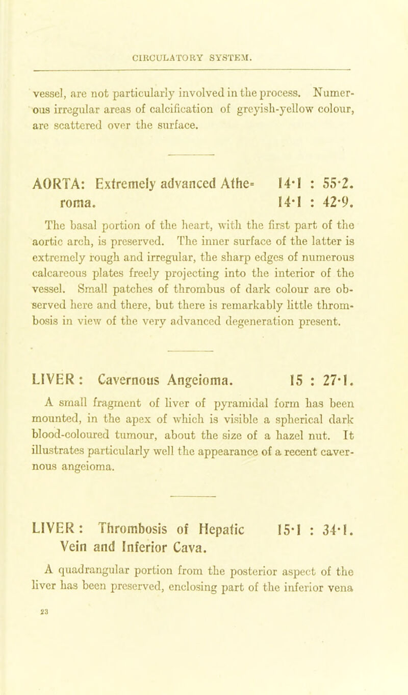 vessel, are not particularly involved in the process. Numer- ous irregular areas of calcification of greyish-yellow colour, are scattered over the surface. AORTA: Extremely advanced Athe= I4-I : 55*2. roma. H*l : 42-9. The basal portion of the heart, with the first part of the aortic arch, is preserved. The inner surface of the latter is extremely rough and irregular, the sharp edges of numerous calcareous plates freely projecting into the interior of the vessel. Small patches of thrombus of dark colour are ob- served here and there, but there is remarkably little throm- bosis in view of the very advanced degeneration present. LIVER: Cavernous Angeioma. 15 : 27*1. A small fragment of hver of pyramidal form has been mounted, in the apex of which is visible a spherical dark blood-coloured tumour, about the size of a hazel nut. It illustrates particularly well the appearance of a recent caver- nous angeioma. LIVER: Thrombosis of Hepatic 15-1 : 34-1. Vein and Inferior Cava. A quadrangular portion from the posterior aspect of the liver has been preserved, enclosing part of the inferior vena