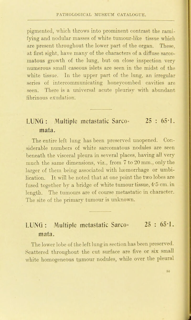 pigmeuted, which throws into prominent contrast the rami- fying and nodular masses of white tumour-like tissue which are present throughout the lower part of the organ. These, at first sight, have many of the characters of a diffuse sarco- matous gro\\i;h of the lung, but on close inspection very numerous small caseous islets are seen in the midst of the wliite tissue. In the upper part of the lung, an irregular series of intercommunicating honeycombed cavities are seen. There is a universal acute pleurisy with abundant fibrinous exudation. LUNG: Multiple metastatic Sarco^ 25 : 65-!. mata. The entire left lung has been preserved unopened. Con- siderable numbers of white sarcomatous nodules are seen beneath the ^'isceral pleura in several places, having all very much the same dimensions, viz., from 7 to 20 mm., only the larger of them being associated with haemorrhage or umbi- lication. It will be noted that at one point the two lobes are fused together by a bridge of white tumour tissue, 4-5 cm. in length. The tumours are of course metastatic in character. The site of the primary tumour is unknown. LUNG: Multiple metastatic Sarco= 25 : 65-1. mata. The lower lobe of the left lung in section has been preserved. Scattered throughout the cut surface are five or six small white homogeneous tjimour nodules, while over the pleural :,<)