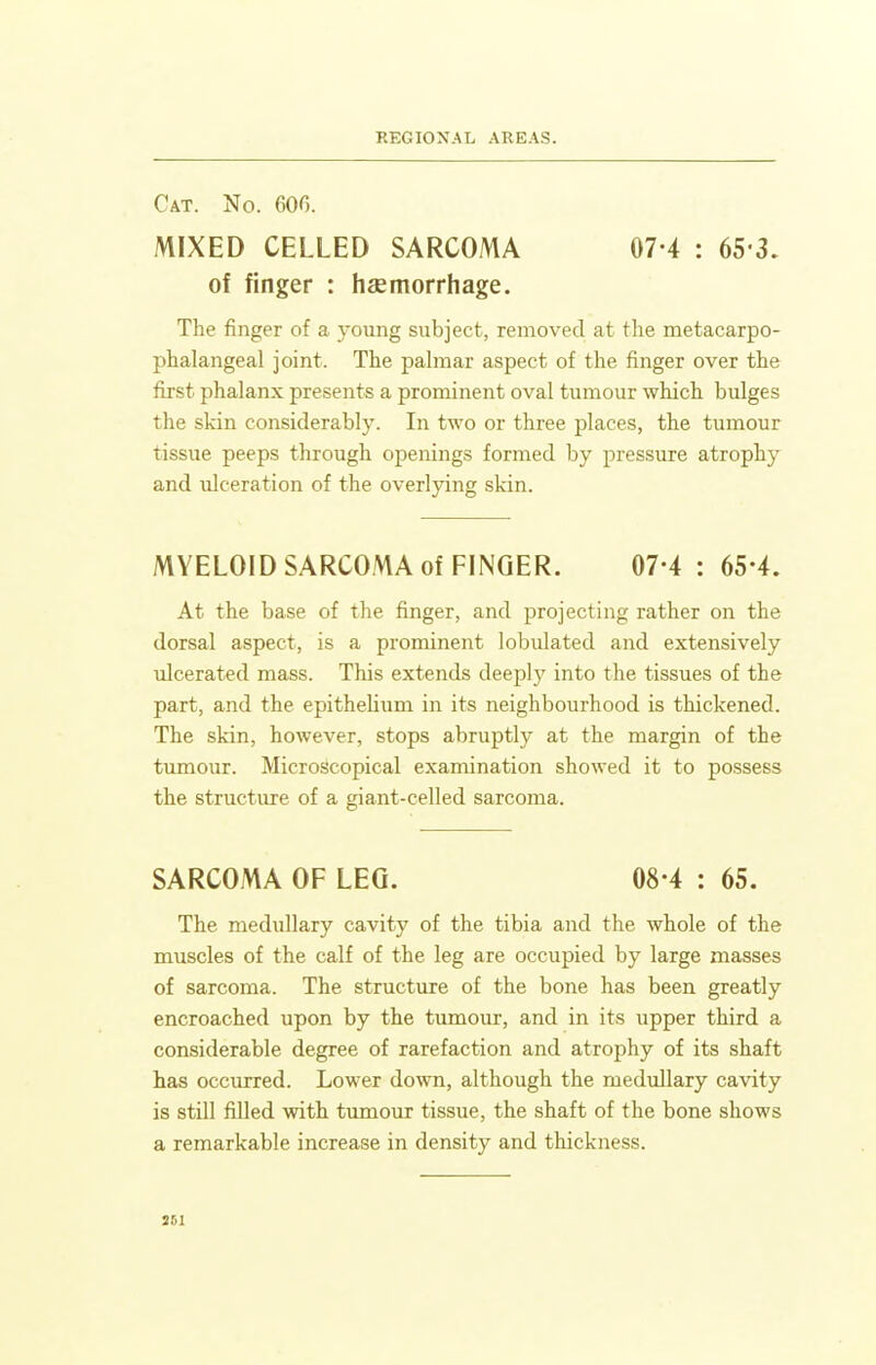 Cat. No. 606. MIXED CELLED SARCOMA 07-4 : 65 3, of finger : haemorrhage. The finger of a young subject, removed at the metacarpo- phalangeal joint. The palmar aspect of the finger over the first phalanx presents a prominent oval tumour which bulges the skin considerably. In two or three places, the tumour tissue peeps through openings formed by pressure atrophy and ulceration of the overlying skin. MYELOID SARCOMA of FINGER. 07-4 : 65-4. At the base of the finger, and projecting rather on the dorsal aspect, is a prominent lobulated and extensively ulcerated mass. This extends deeplj' into the tissues of the part, and the epitheUum in its neighbourhood is thickened. The skin, however, stops abruptly at the margin of the tumour. Microscopical examination showed it to possess the structure of a giant-celled sarcoma. SARCOMA OF LEG. 08-4 : 65. The medullary cavity of the tibia and the whole of the muscles of the calf of the leg are occupied by large masses of sarcoma. The structure of the bone has been greatly encroached upon by the tumour, and in its upper third a considerable degree of rarefaction and atrophy of its shaft has occurred. Lower down, although the medullary cavity is still filled with tumour tissue, the shaft of the bone shows a remarkable increase in density and thickness. 261
