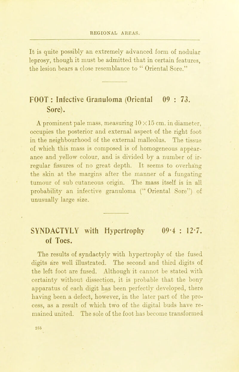 It is quite possibly an extremely advanced form of nodular leprosy, though it must be admitted that in certain features, the lesion bears a close resemblance to  Oriental Sore. FOOT : Infective Granuloma (Oriental 09 : 73. Sore). A prominent pale mass, measuring 10 X15 cm. in diameter, occupies the posterior and external aspect of the right foot in the neighbourhood of the external malleolus. The tissue of which this mass is composed is of homogeneous appear- ance and yellow colour, and is divided by a number of ir- regular fissures of no great depth. It seems to overhang the skin at the margins after the manner of a fungating tumour of sub cutaneous origin. The mass itself is in all probability an infective granuloma ( Oriental Sore) of unusually large size. SYNDACTYLY with Hypertrophy 09-4 : 12-7. of Toes. The results of syndactyly with hypertrophy of the fused digits are well illustrated. The second and third digits of the left foot are fused. Although it cannot be stated with certainty without dissection, it is probable that the bony apparatus of each digit has been perfectly developed, there having been a defect, however, in the later part of the pro- cess, as a result of which two of the digital buds have re- mained united. The sole of the foot has become transformed 2S5