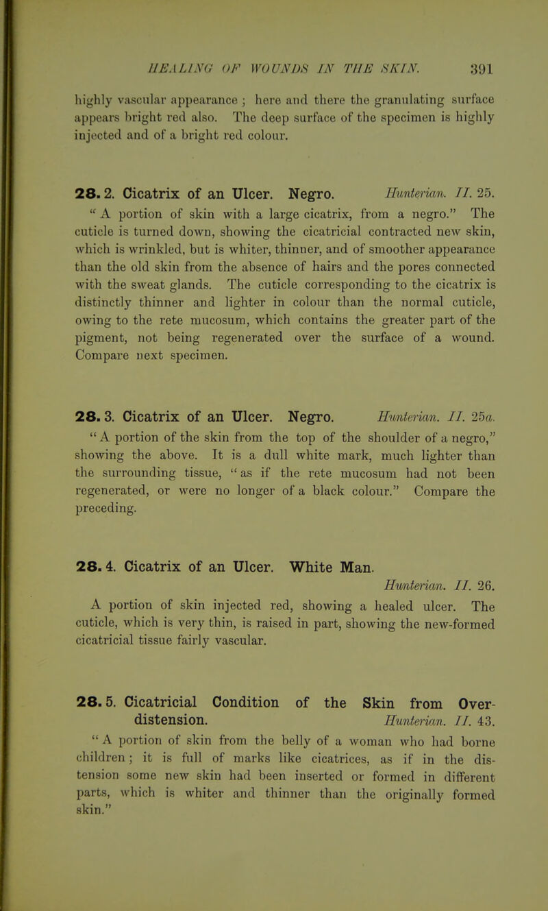 highly vascular appearance ; here and there the granulating surface appears bright red also. The deep surface of the specimen is highly injected and of a bright red colour. 28.2. Cicatrix of an Ulcer. Negro. Hunterian. II. 25.  A portion of skin with a large cicatrix, from a negro. The cuticle is turned down, showing the cicatricial contracted new skin, which is wrinkled, but is whiter, thinner, and of smoother appearance than the old skin from the absence of hairs and the pores connected with the sweat glands. The cuticle corresponding to the cicatrix is distinctly thinner and lighter in colour than the normal cuticle, owing to the rete mucosum, which contains the greater part of the pigment, not being regenerated over the surface of a wound. Compare next specimen. 28.3. Cicatrix of an Ulcer. Negro. Hunterian. II. 25a. A portion of the skin from the top of the shoulder of a negro, showing the above. It is a dull white mark, much lighter than the surrounding tissue,  as if the rete mucosum had not been regenerated, or were no longer of a black colour. Compare the preceding. 28.4. Cicatrix of an Ulcer. White Man. Hwiterian. II. 26. A portion of skin injected red, showing a healed ulcer. The cuticle, which is very thin, is raised in part, showing the new-formed cicatricial tissue fairly vascular. 28.5. Cicatricial Condition of the Skin from Over- distension. Hunterian. II. 43.  A portion of skin from the belly of a woman who had borne children; it is full of marks like cicatrices, as if in the dis- tension some new skin had been inserted or formed in different parts, which is whiter and thinner than the originally formed skin.