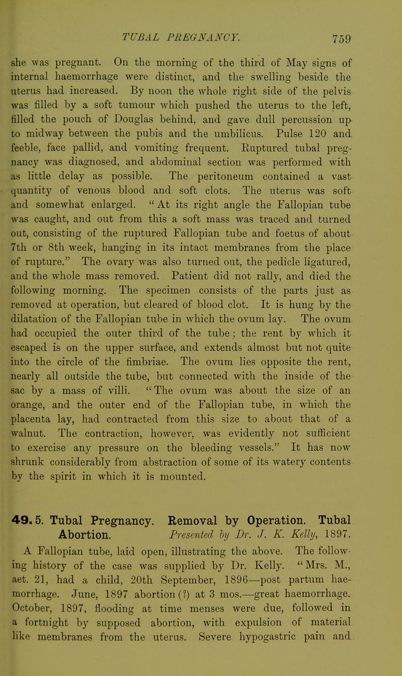 she was pregnant. On the morning of the third of May signs of internal haemorrhage were distinct, and the swelling beside the uterus had increased. By noon the whole right side of the pelvis was filled by a soft tumour which pushed the uterus to the left, filled the pouch of Douglas behind, and gave dull percussion up- to midway between the pubis and the umbilicus. Pulse 120 and feeble, face pallid, and vomiting frequent. Ruptured tubal preg- nancy was diagnosed, and abdominal section was performed with as little delay as possible. The peritoneum contained a vast quantity of venous blood and soft clots. The uterus was soft and somewhat enlarged.  At its right angle the Fallopian tube was caught, and out from this a soft mass was traced and turned out, consisting of the ruptured Fallopian tube and foetus of about 7th or 8th week, hanging in its intact membranes from the place of rupture. The ovary was also turned out, the pedicle ligatured, and the whole mass removed. Patient did not rally, and died the following morning. The specimen consists of the parts just as removed at operation, but cleared of blood clot. It is hung by the dilatation of the Fallopian tube in which the ovum lay. The ovum had occupied the outer third of the tube; the rent by which it escaped is on the upper surface, and extends almost but not quite into the circle of the fimbriae. The ovum lies opposite the rent, nearly all outside the tube, but connected with the inside of the sac by a mass of villi. The ovum was about the size of an orange, and the outer end of the Fallopian tube, in which the placenta lay, had contracted from this size to about that of a walnut. The contraction, however, was evidently not sufficient to exercise any pressure on the bleeding vessels, It has now shrunk considerably from abstraction of some of its watery contents by the spirit in which it is mounted. 49.5. Tubal Pregnancy. Removal by Operation. Tubal Abortion. Presented by Br. J. K. Kelly, 1897. A Fallopian tube, laid open, illustrating the above. The follow- ing history of the case was supplied by Dr. Kelly. Mrs. M., aet. 21, had a child, 20th September, 1896—post partum hae- morrhage. June, 1897 abortion (?) at 3 mos.—great haemorrhage. October, 1897, flooding at time menses were due, followed in a fortnight by supposed abortion, with expulsion of material like membranes from the uterus. Severe hypogastric pain and